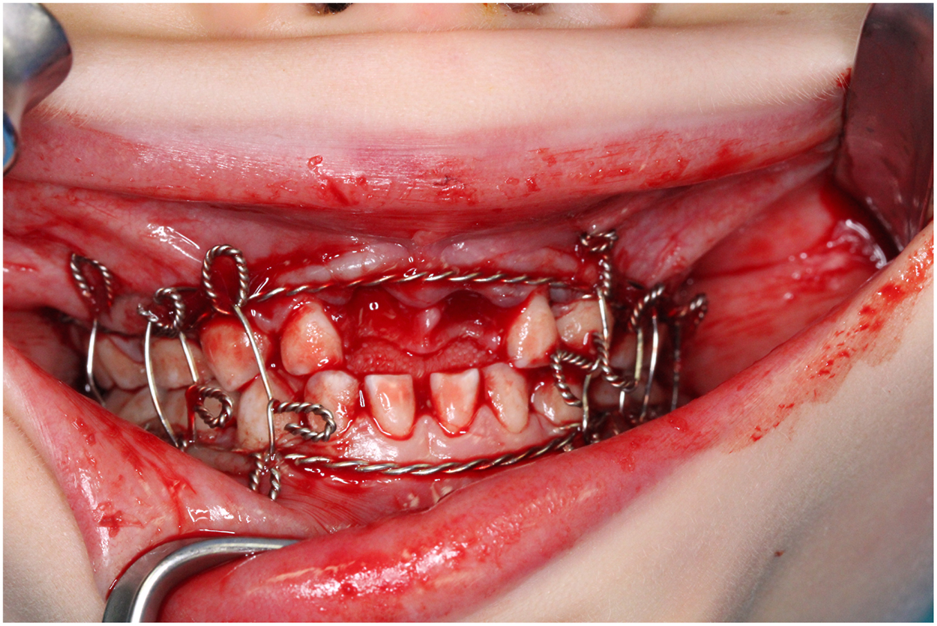 A photograph shows Risdon cables secured around the teeth and gums of a patient to stabilize the occlusion following bilateral subcondylar fractures.