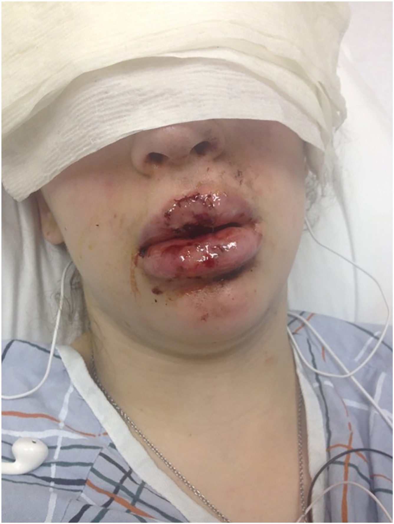 A clinical photograph of a teenage patient with facial and lip injuries immediately after an e cigarette explosion.