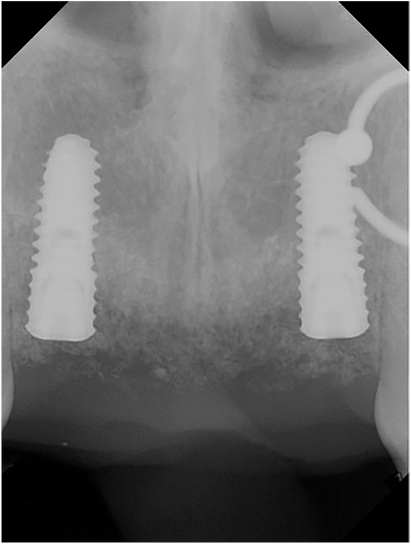 A periapical dental radiograph showing two implants placed in the anterior maxilla at the sites of previously missing central incisors.