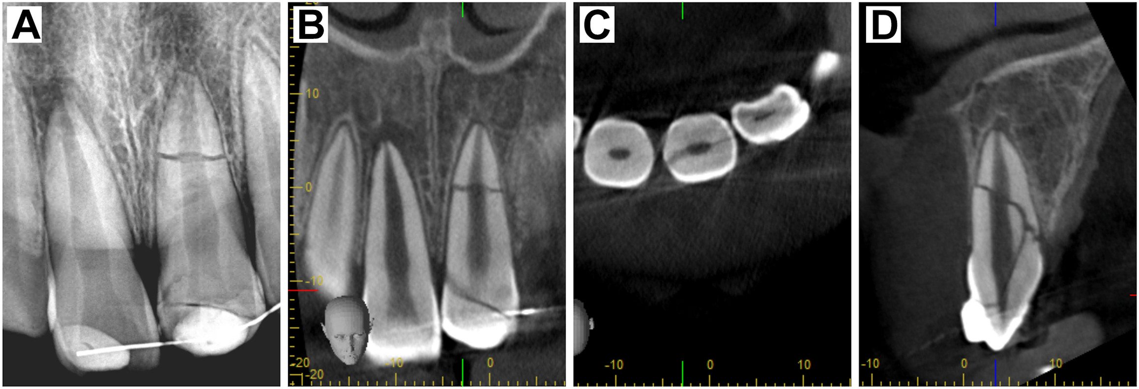 A periapical radiograph and three C B C T scans show crown and root fractures in a maxillary left central incisor.