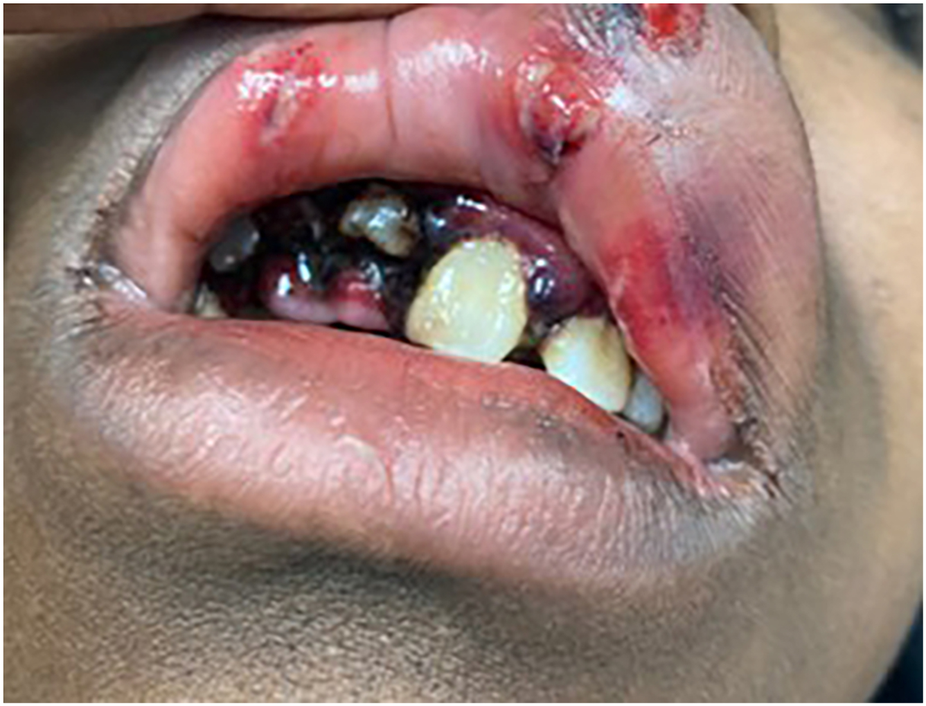 A close-up intraoral view reveals severe dental trauma with lacerated lips and severely displaced, overlapping upper front teeth embedded in heavily bruised, bleeding, and swollen dark gums.