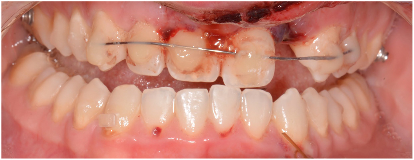 A close-up intraoral view shows a metal splint wire attached to the upper front teeth with visible bleeding on the upper gums, indicating recent trauma and dental treatment.
