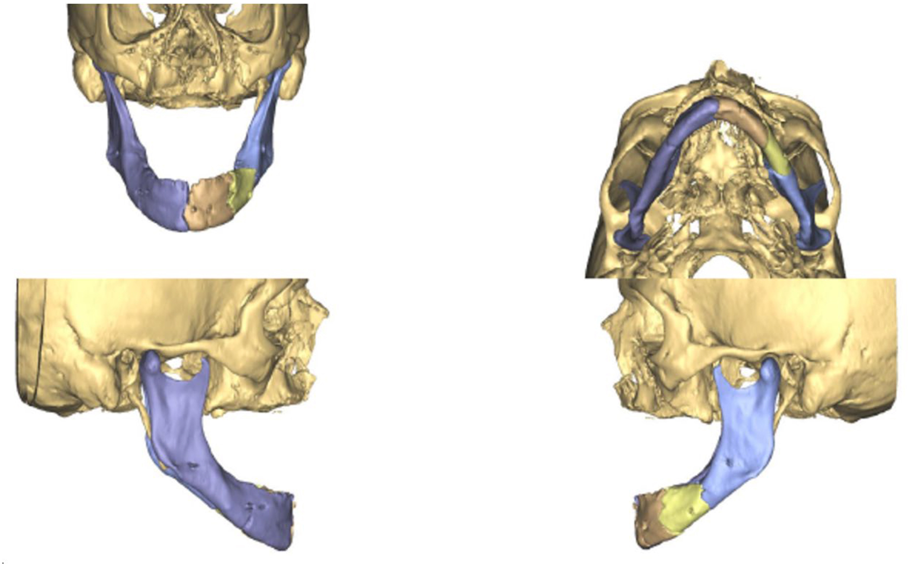 A four-view composite of three-dimensional C T reconstruction scans depicts a fractured mandible with segmented bone fragments repositioned into ideal alignment for virtual surgical planning.