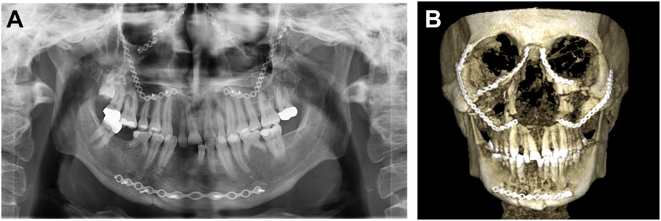 A panoramic radiograph and a 3 D reconstruction show the postoperative evaluation of malocclusion following internal fixation of panfacial injuries.