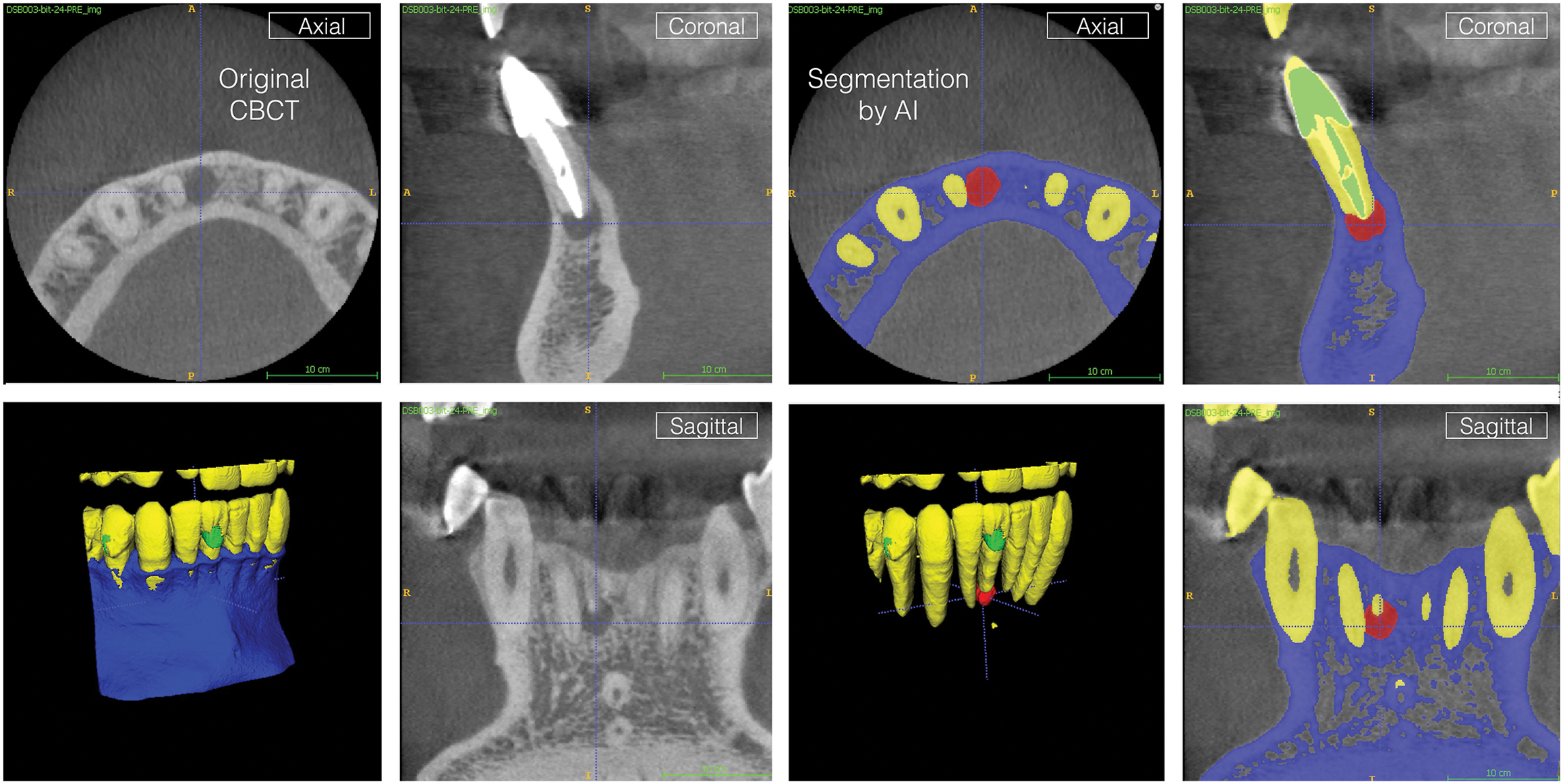 A set of eight panels compares regular C B C T dental scans with A I-generated three-dimensional segmentations of the same area, to detect and outline a periapical lesion near a lower front tooth.