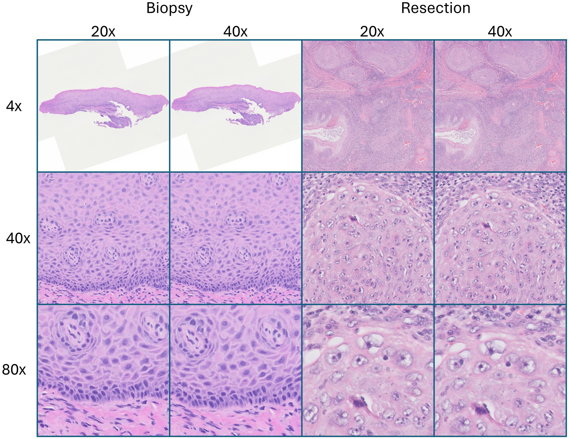 An illustration compares biopsy and resection tissue samples viewed under different magnifications.