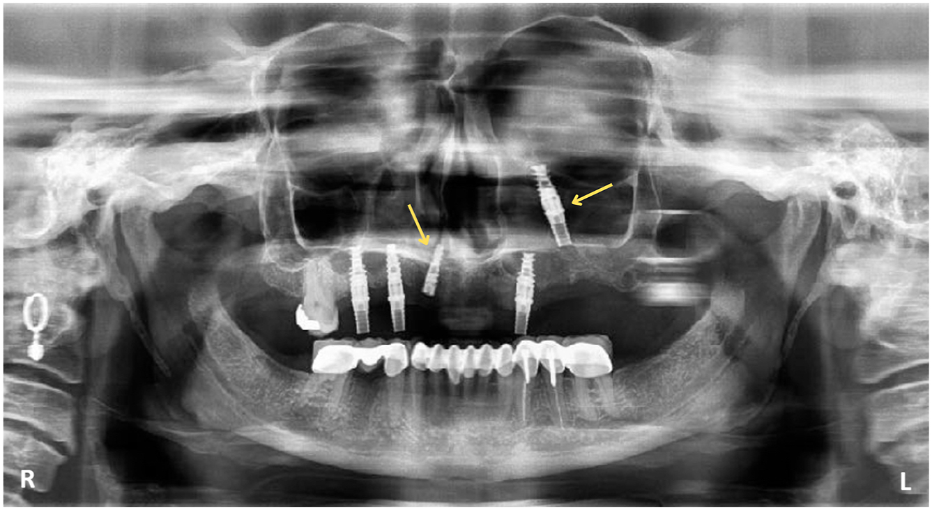 A panoramic dental radiograph presents multiple upper and lower jaw implants.