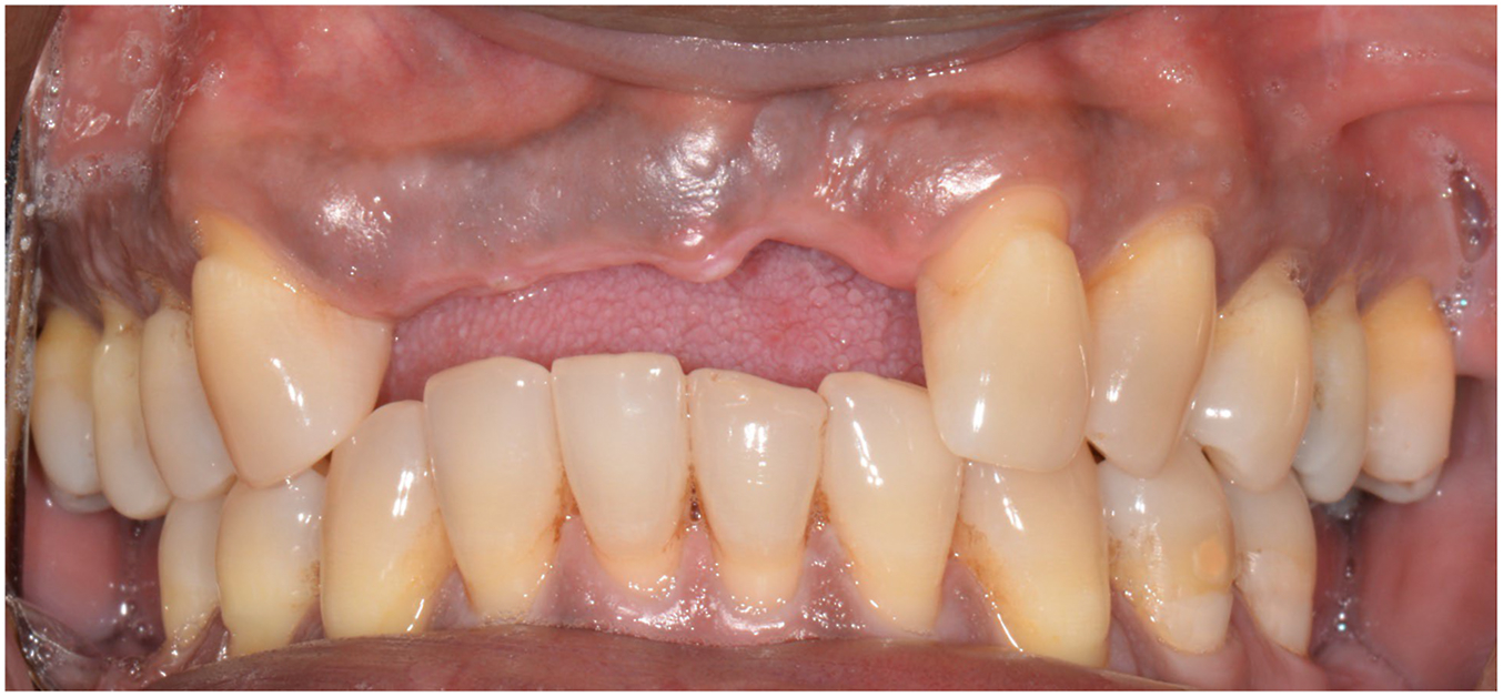 An intraoral view shows a severe dental defect in the upper front jaw where three adjacent teeth are missing, leaving a large, concave gap in the gum tissue.