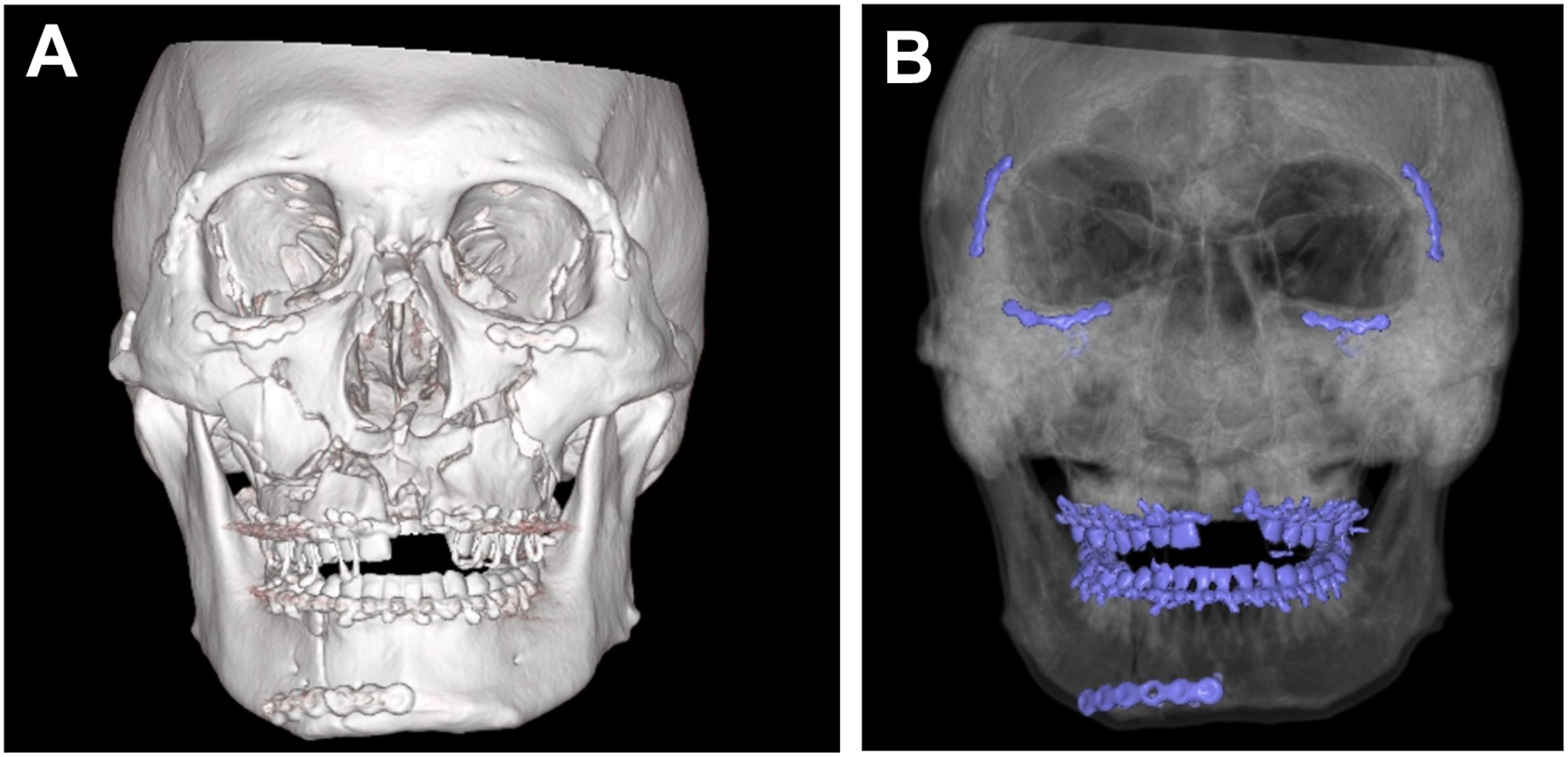 A two-panel composite of a three-dimensional C T reconstruction scan and a maximum intensity projection scan depicts postoperative facial fracture reduction with implanted hardware.