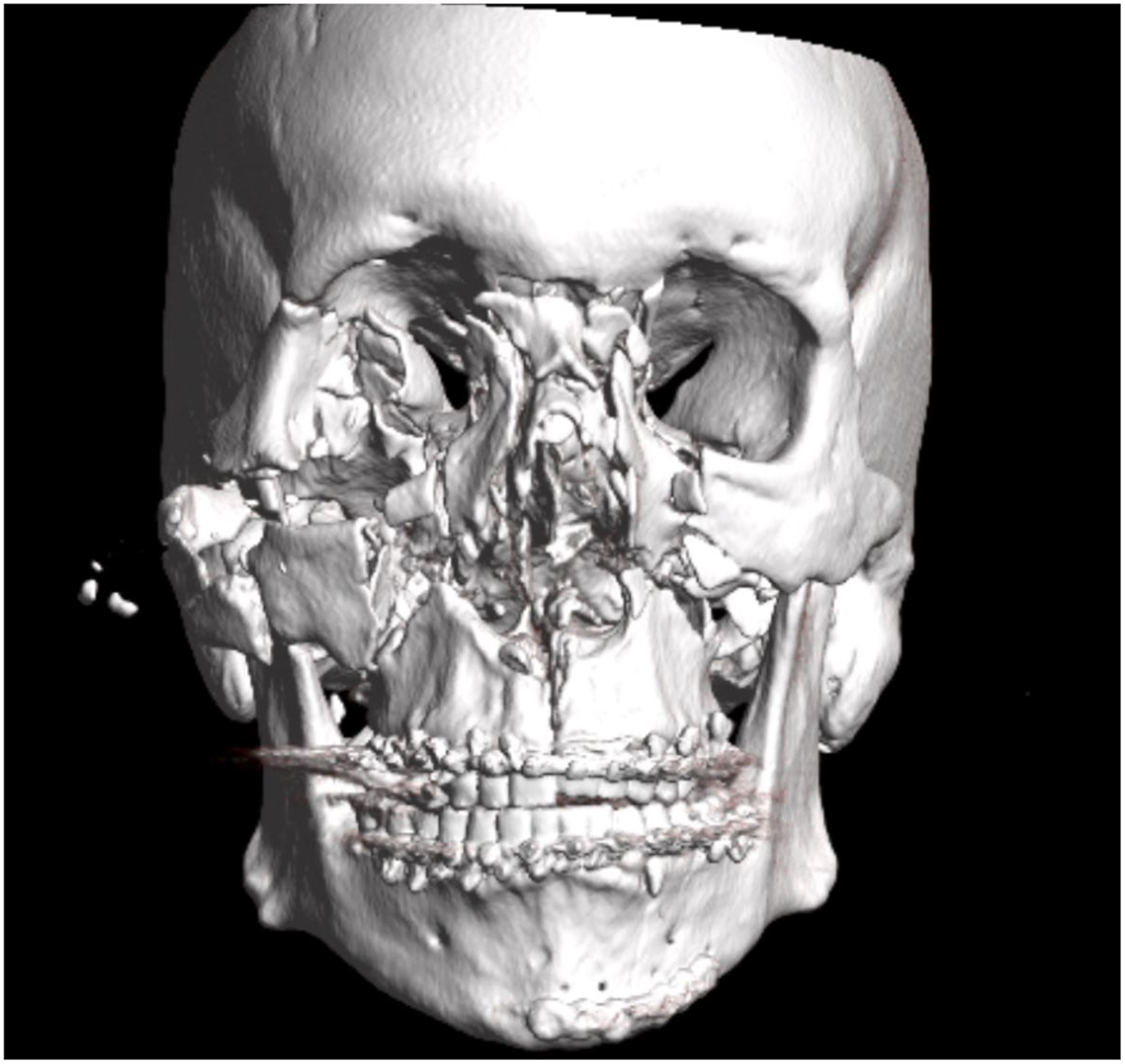 A three-dimensional C T reconstruction scan of the facial skeleton depicts bilateral parasymphyseal mandibular, Le Fort 1, and comminuted nasal, orbital, and ethmoidal fractures.