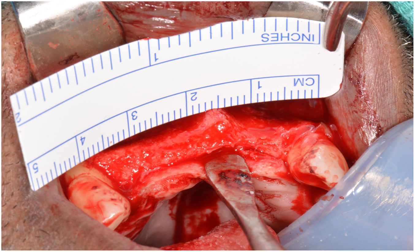 A pre-surgical view of an exposed upper jawbone with a sterile ruler measuring a severely thin, bloody alveolar ridge before grafting.