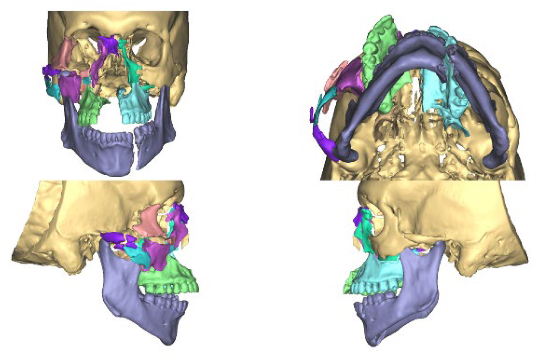A four-view composite of C T reconstruction scans depicts color-segmented fractured anatomical subunits of the midface and mandible for virtual surgical reconstruction planning.