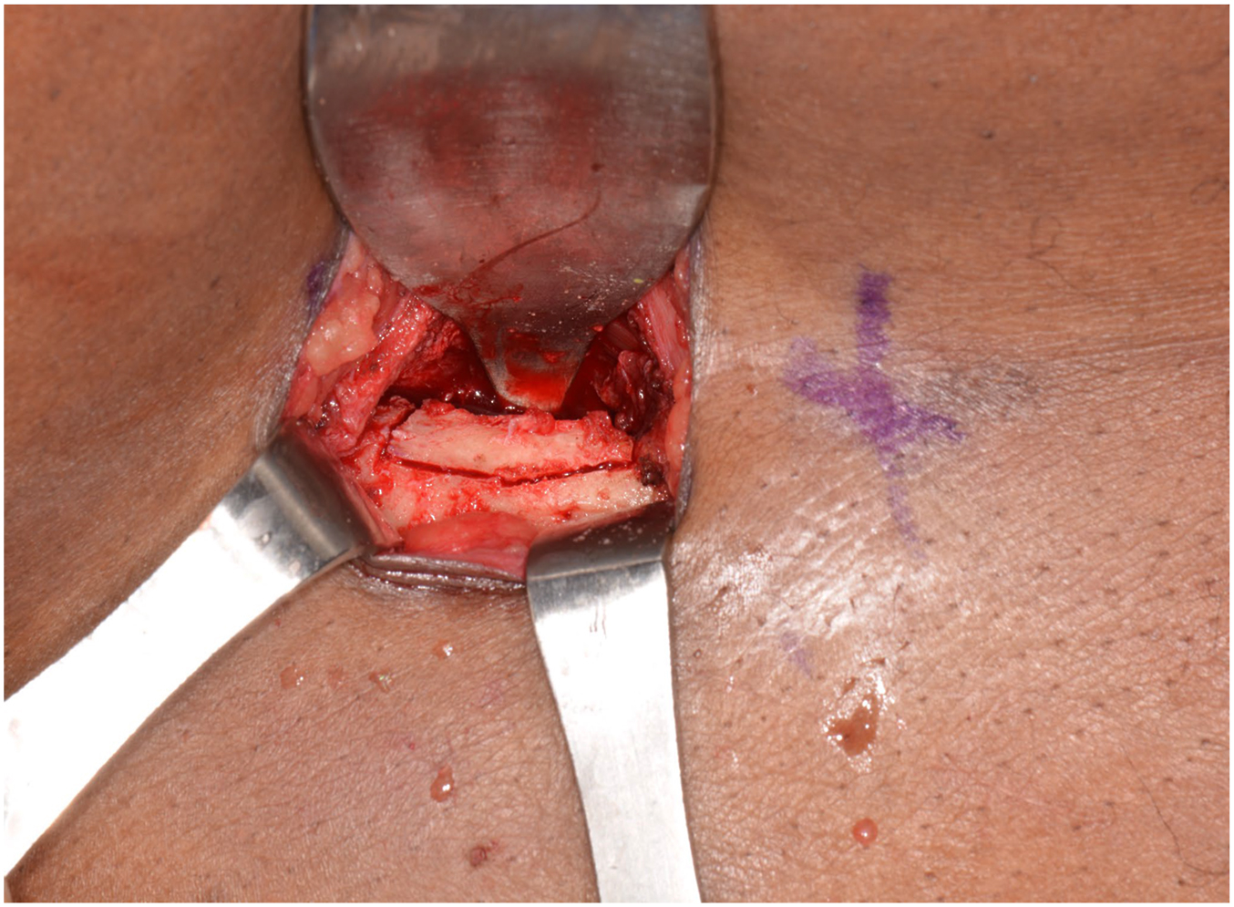 A clinical photo shows a surgical incision on the hip that exposes the iliac crest, where metal retractors hold open the tissue to harvest a rectangular block of bone.