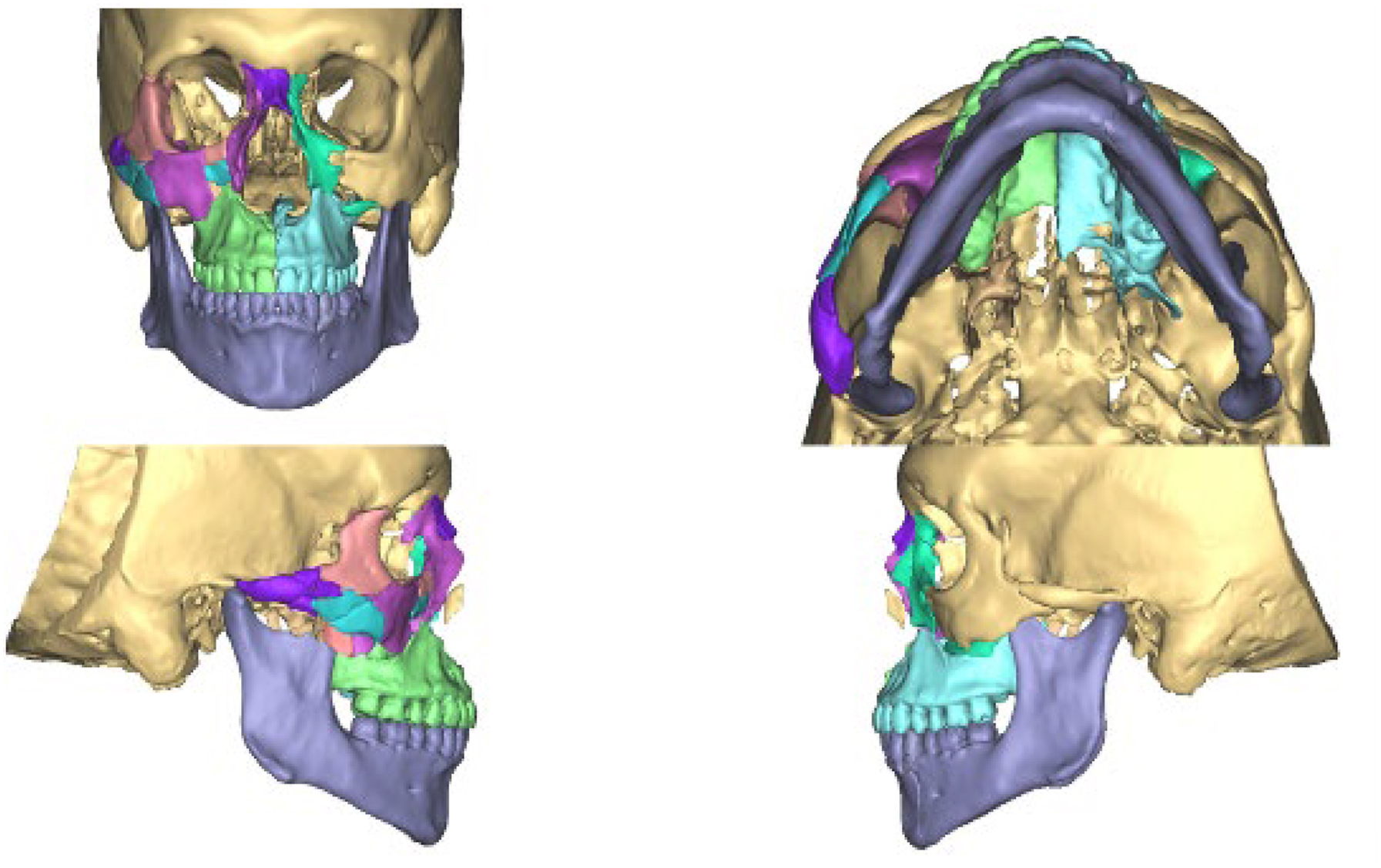A four-view composite of C T reconstruction scans depicts color-segmented fractured midface and mandibular subunits virtually repositioned into ideal alignment for surgical reconstruction.