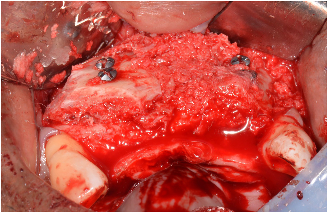 An intraoperative view of the upper jaw shows a large, thick block of bone graft secured with two metal screws over the previously thin ridge.