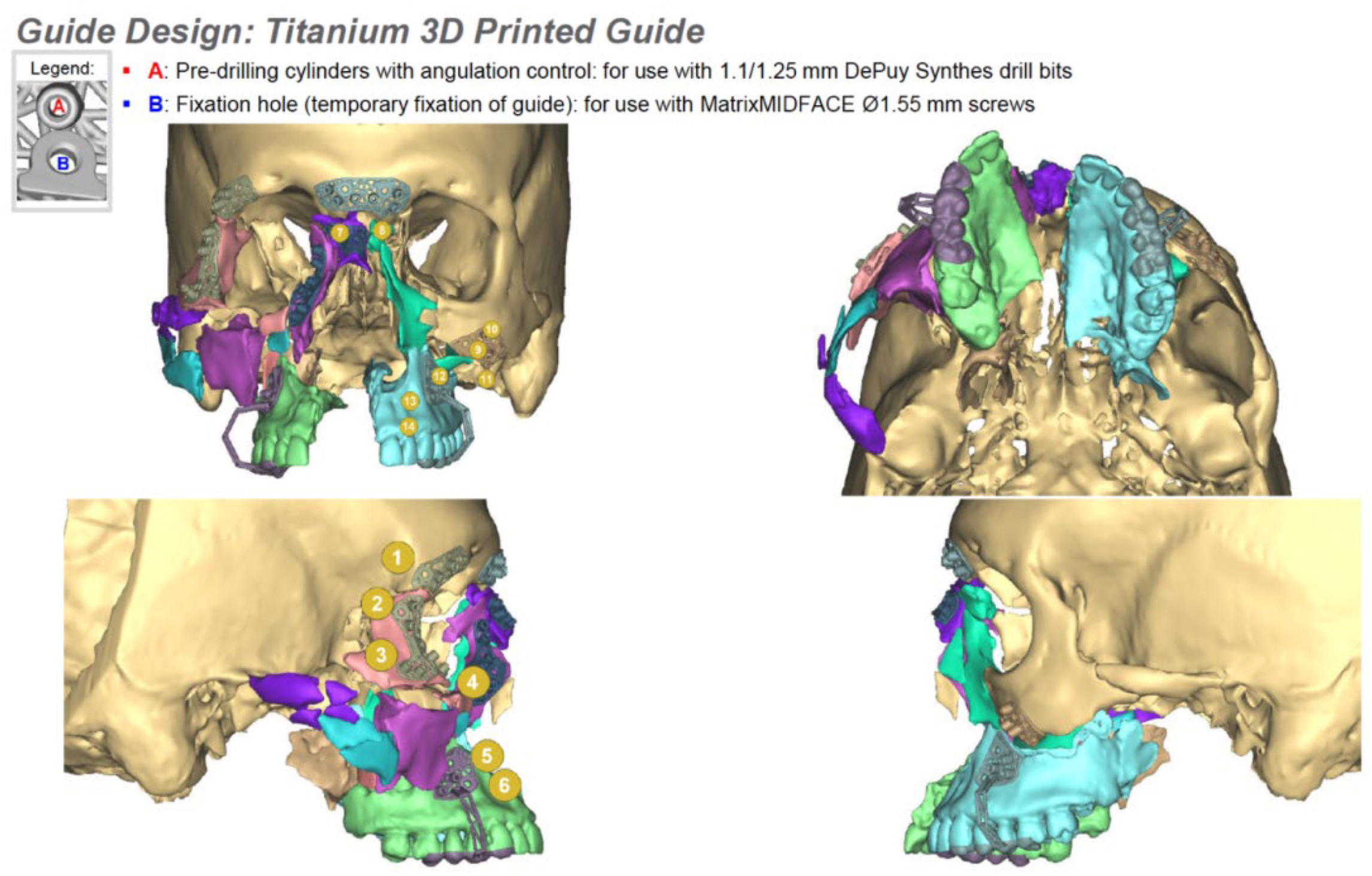 A four-view composite of C T reconstruction scans with a legend depicts four custom titanium three-dimensional printed surgical guides with numbered pre-drilling cylinders and fixation holes.