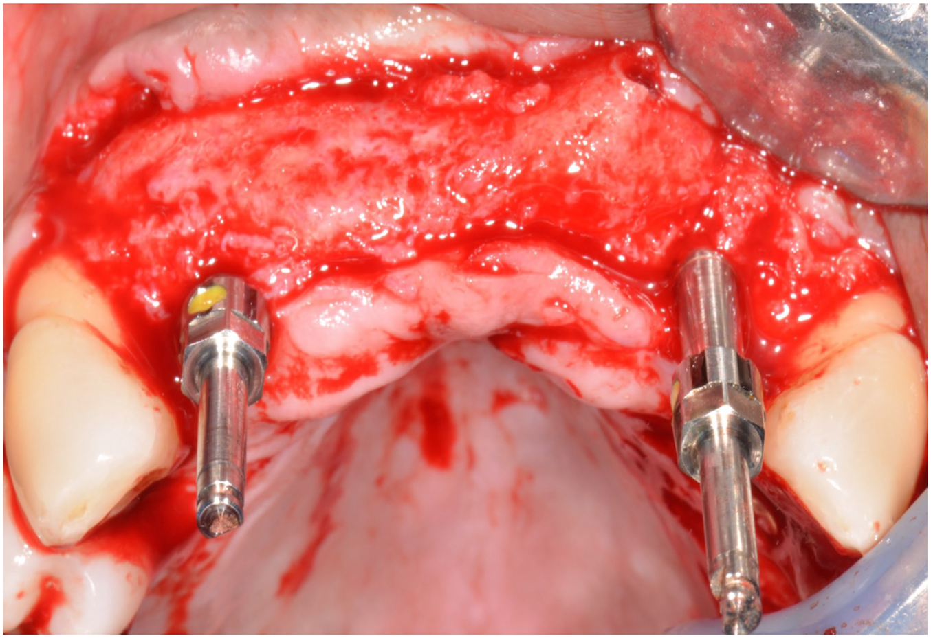 An intraoperative surgical view of a fully healed, thick upper jawbone with two metal guide pins inserted to mark the positions for new dental implants.