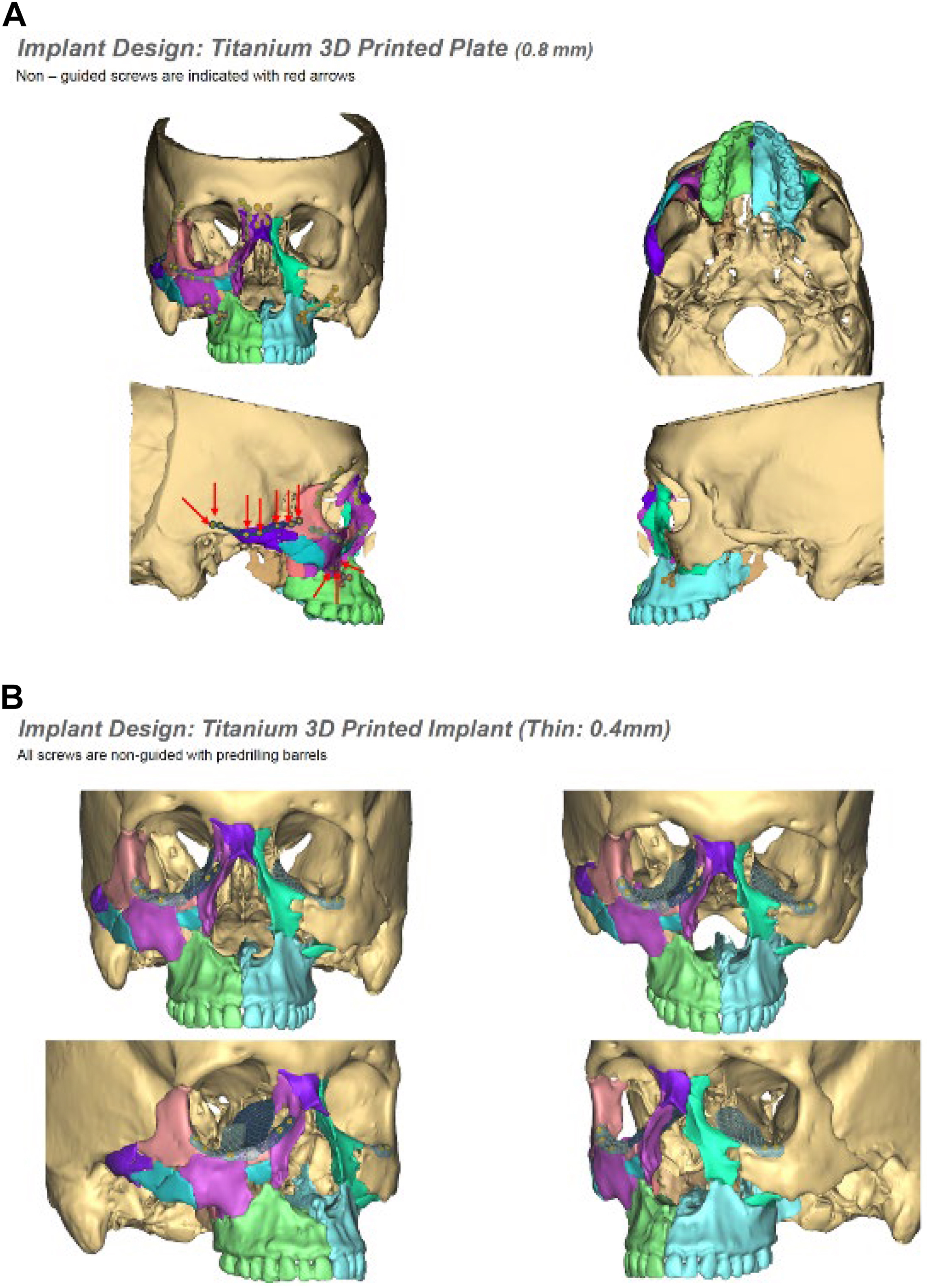 A two-panel composite labeled A and B of multi-view C T reconstruction scans depicts a titanium three-dimensional printed plate and a thin titanium implant with labeled design specifications.
