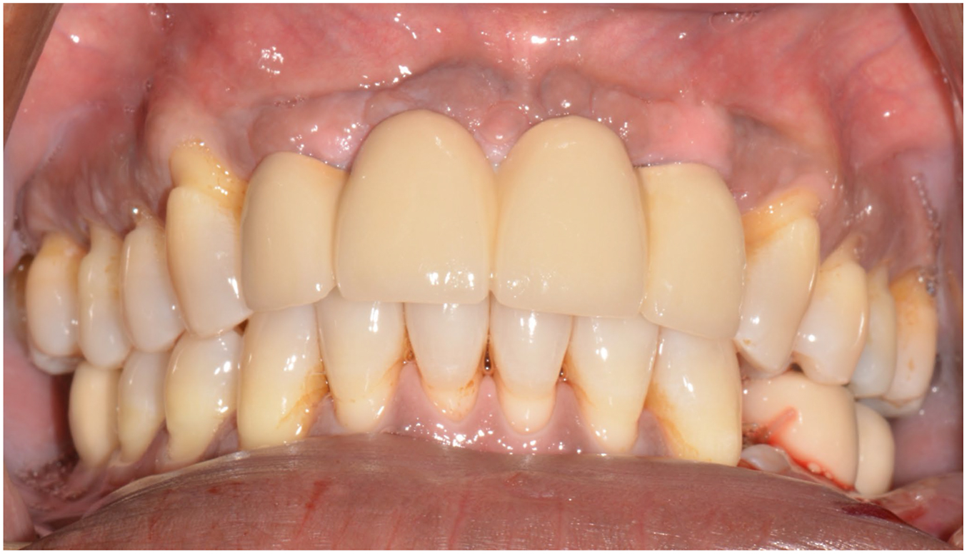 A close-up view of a patient's teeth reveals four perfectly aligned, natural-looking artificial upper front teeth resting against healthy gums.