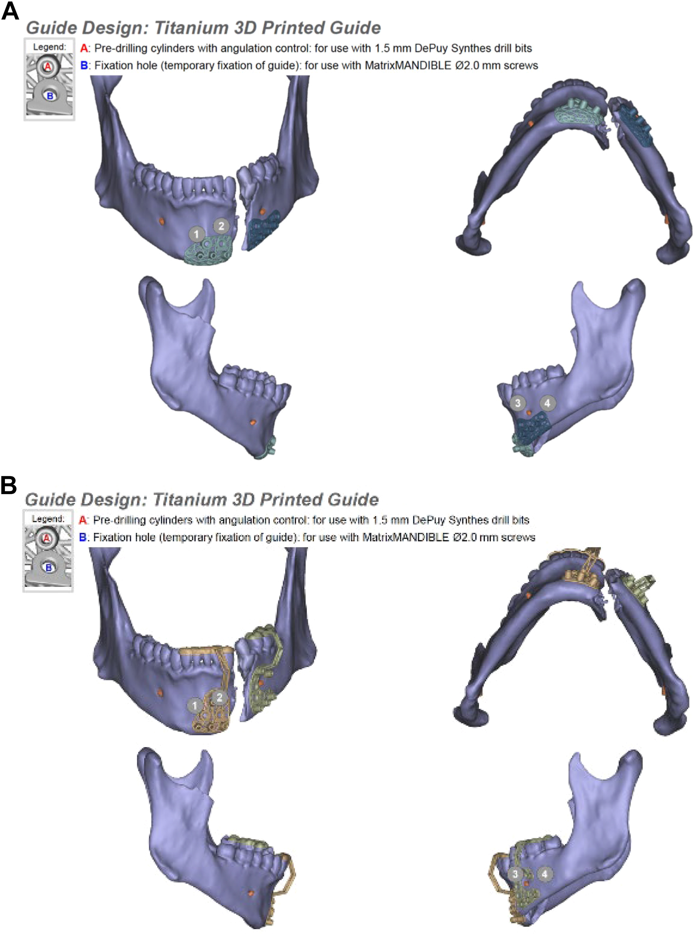 A two-panel composite labeled A and B of multi-view C T reconstruction scans of the mandible depicts bone-borne and tooth-borne titanium three-dimensional printed surgical guide options.