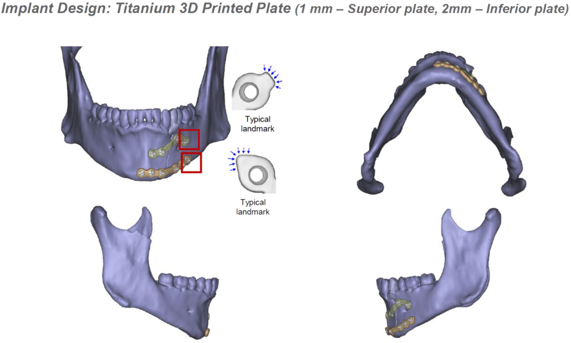 A four-view composite of C T reconstruction scans of the mandible depicts two rigid plates with landmark markers and pre-drilled screw positions designed to avoid the mental foramen.