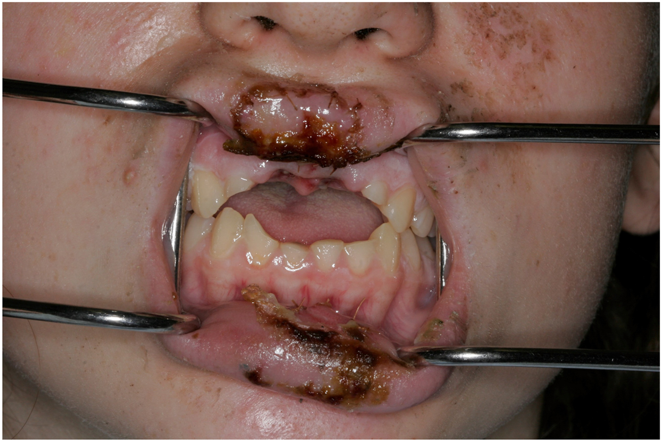 A clinical photograph of a teenage patient mouth held open with retractors showing healing injuries to the lips and oral tissues after an e cigarette explosion.