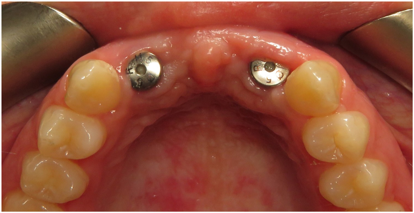 An occlusal intraoral photograph showing two implant abutments in the upper anterior region with surrounding teeth.
