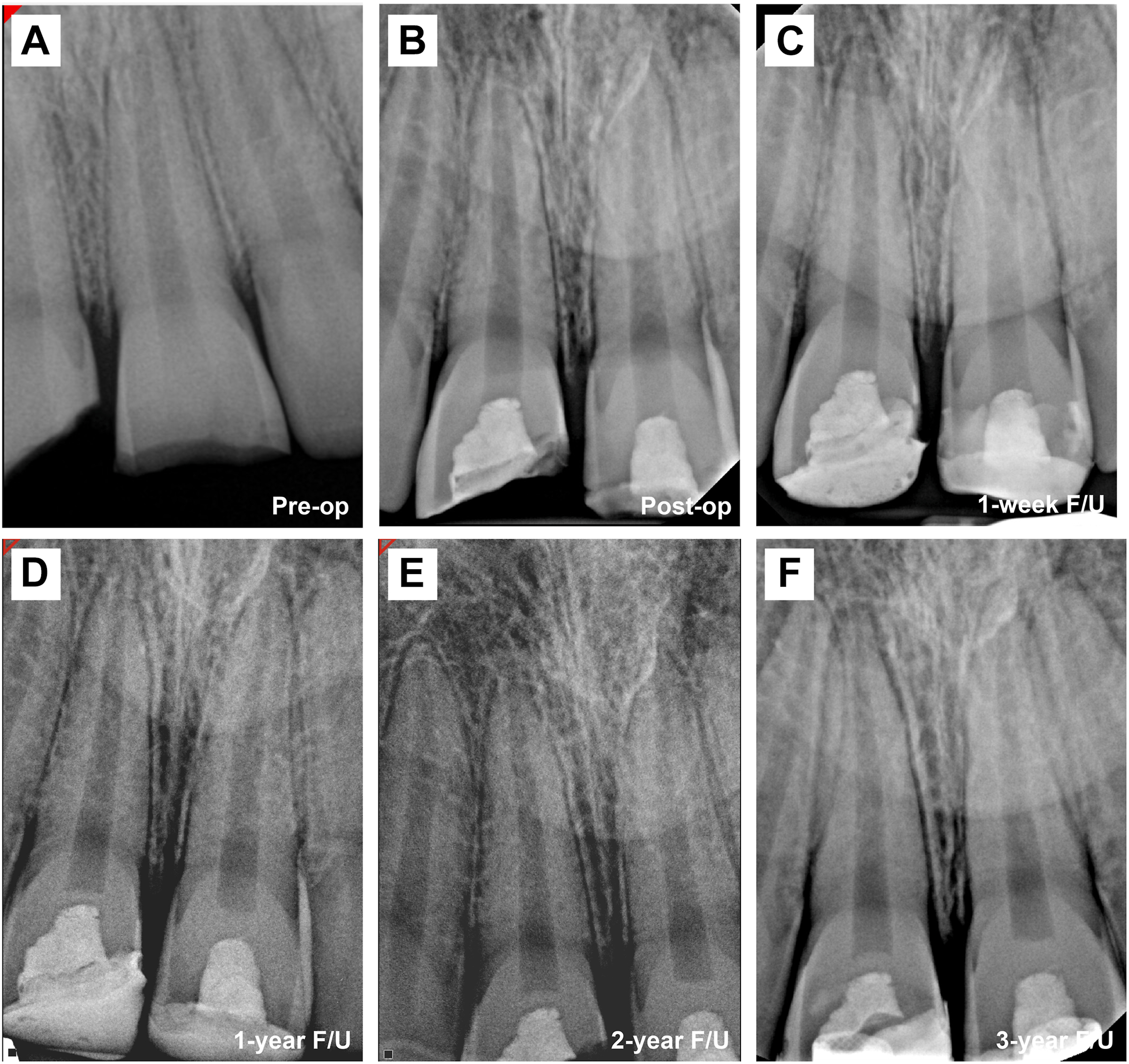 A set of six periapical radiographs shows a three year follow up of a partial pulpotomy in the maxillary central incisors of an eleven year old male.