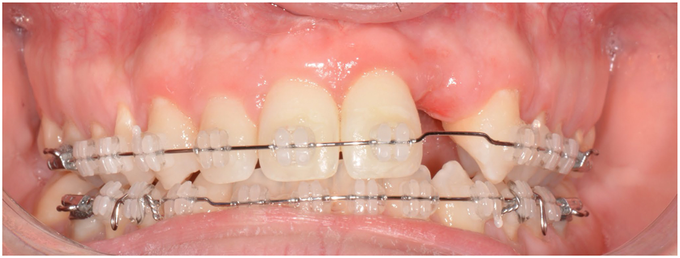A close-up intraoral view shows the upper and lower teeth fitted with clear orthodontic brackets and metal archwires, highlighting a significant gap and gum tissue loss where a tooth is missing.