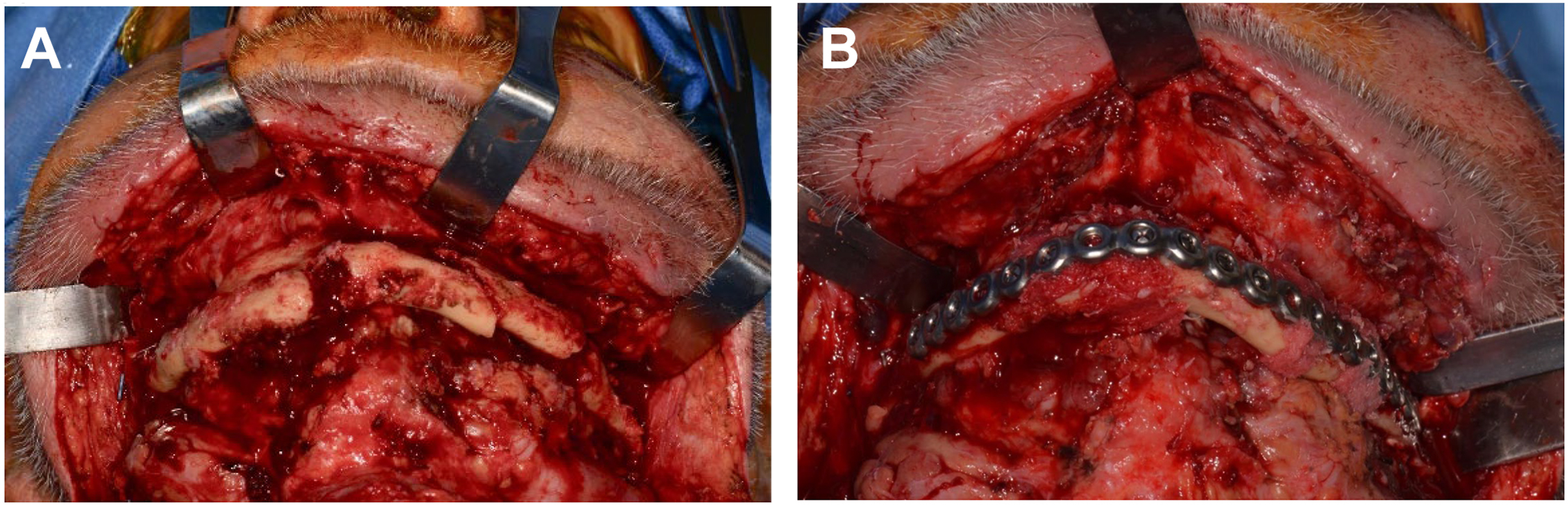 A two-panel composite of intraoperative photographs labeled A and B shows exposure of a fractured mandible through a submandibular approach and placement of a custom reconstruction plate.