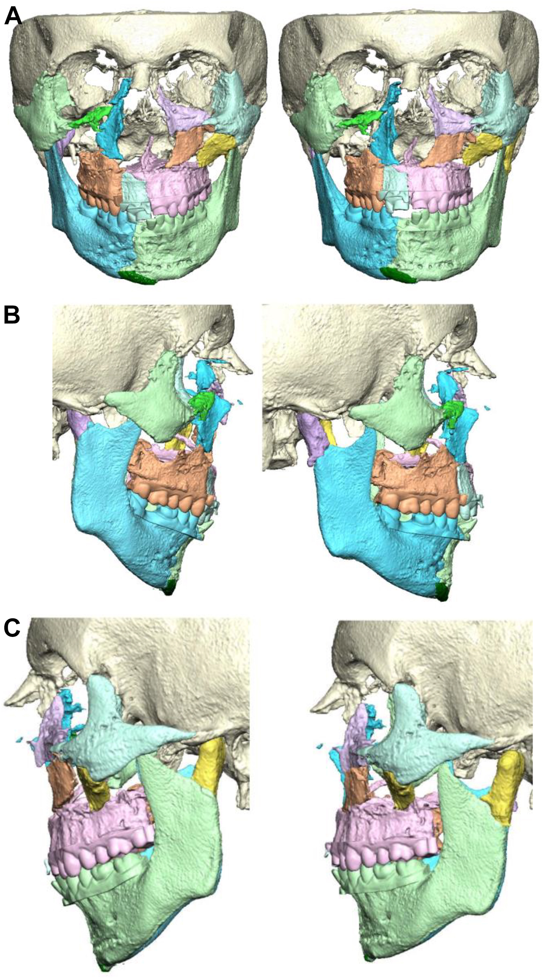 A set of six 3 D reconstructions shows virtual surgical planning for osteotomy site location, reduction of multiple fractured segments, and the modification of a patient's occlusion.