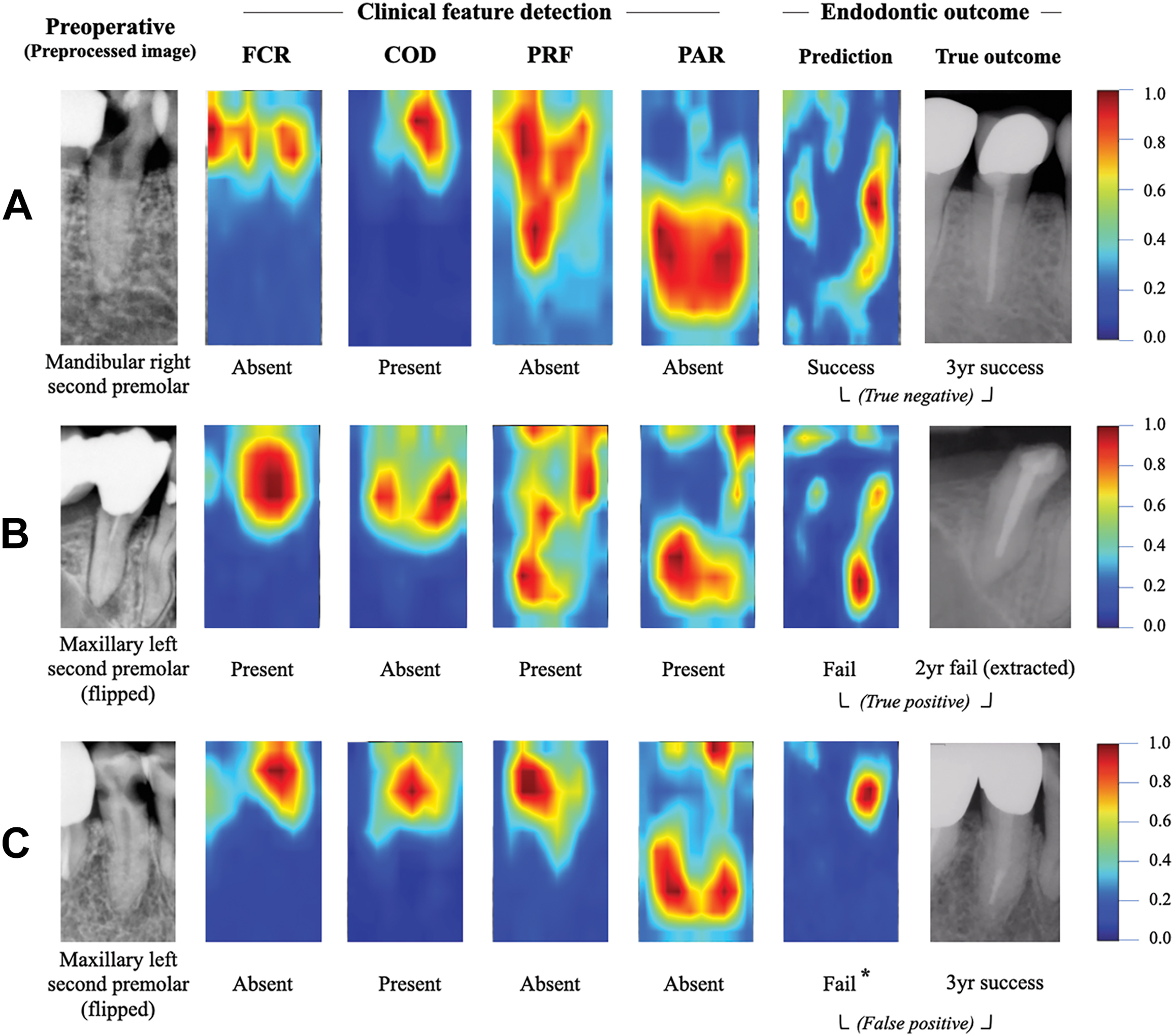 Three dental radiographs alongside heat maps highlight the areas an A I model focused on when identifying specific tooth problems and predicting treatment outcomes.