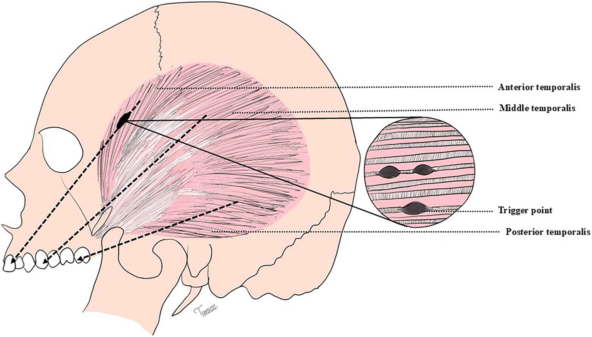 A diagram of the head displays referred pain areas of the temporalis muscle with markings over the temple, eye region, and side of the face.