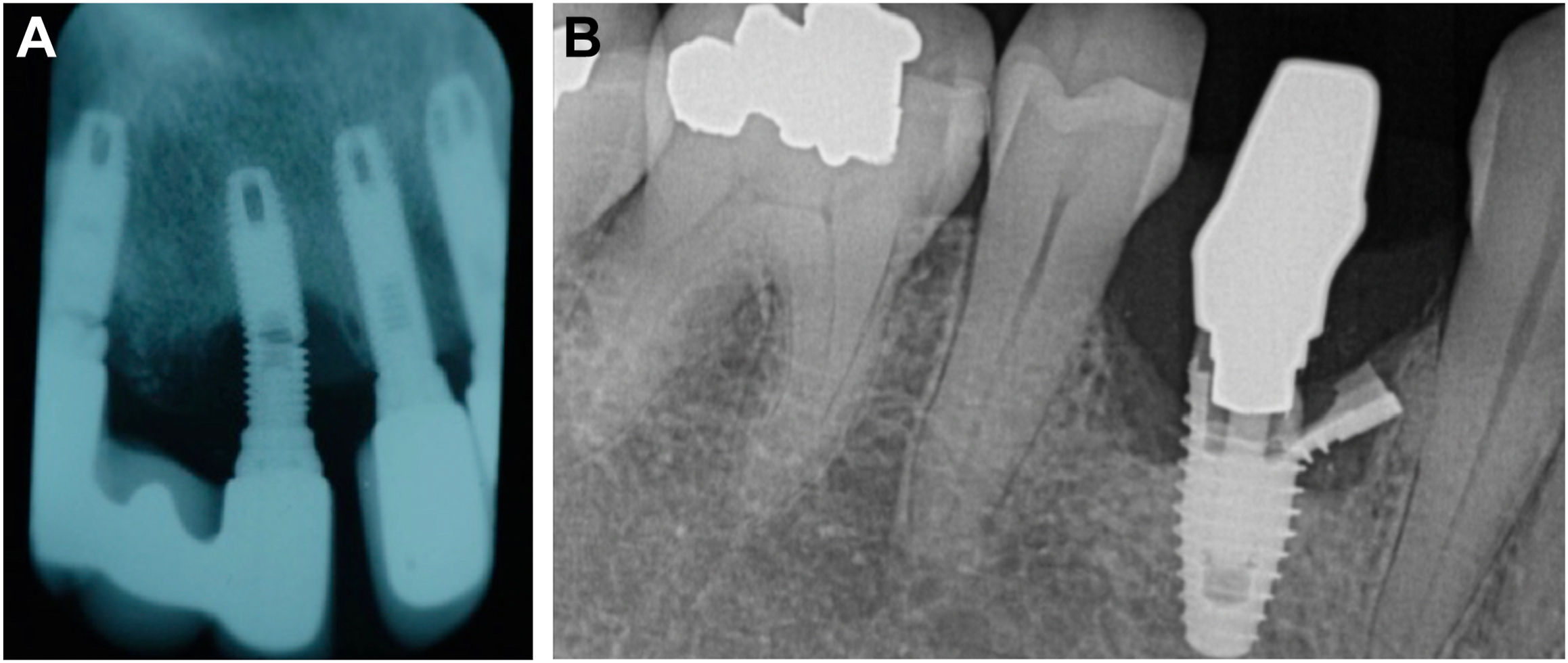 Two intraoral periapical radiographs illustrates a double implant fracture and an implant fracture in the mandibular premolar region.