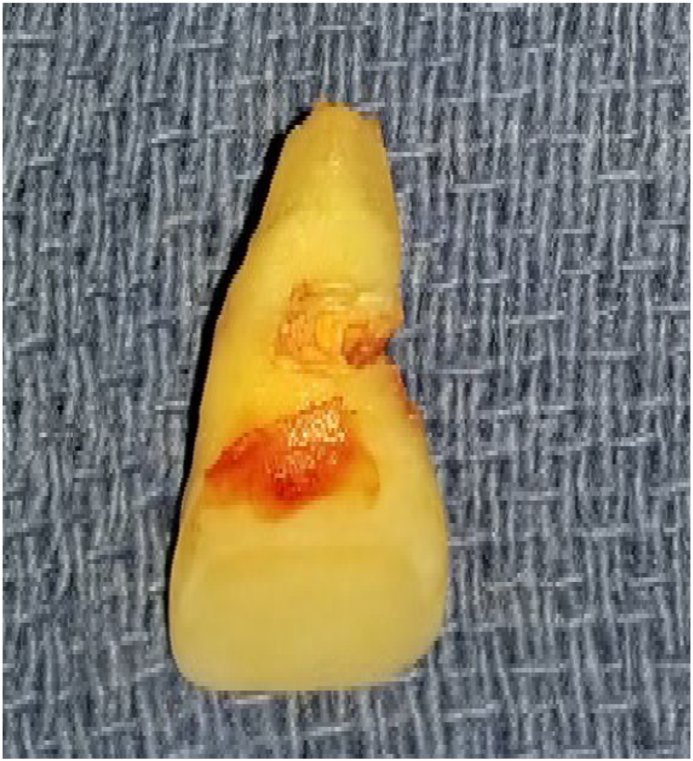 A clinical photo shows an extracted human tooth resting on a surgical drape, featuring large, irregular crater-like defects on its root structure, indicative of severe tissue breakdown.