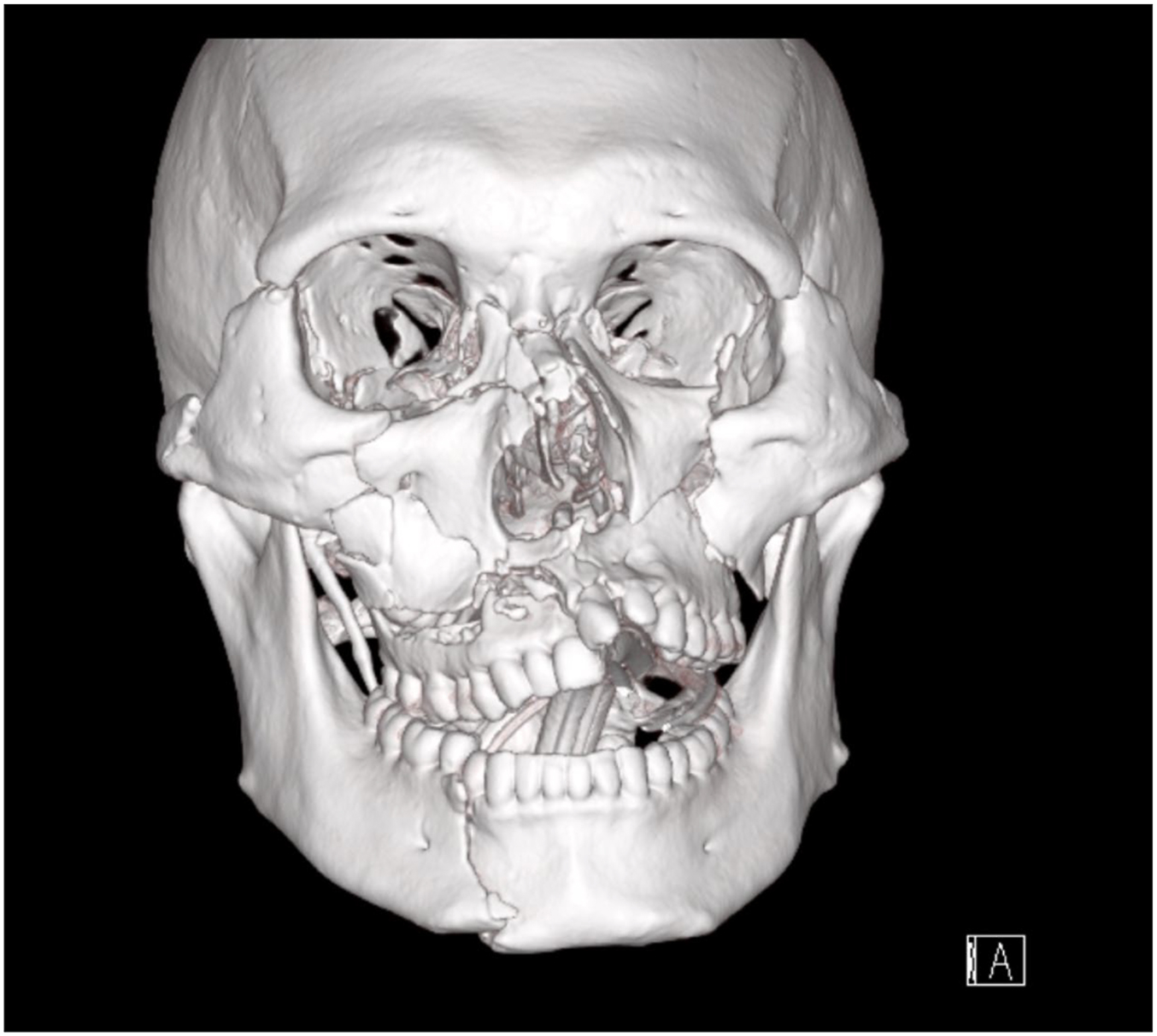 A three-dimensional C T reconstruction scan of the facial skeleton in frontal view depicts extensive multifocal facial fractures with an endotracheal tube in place at the time of imaging.