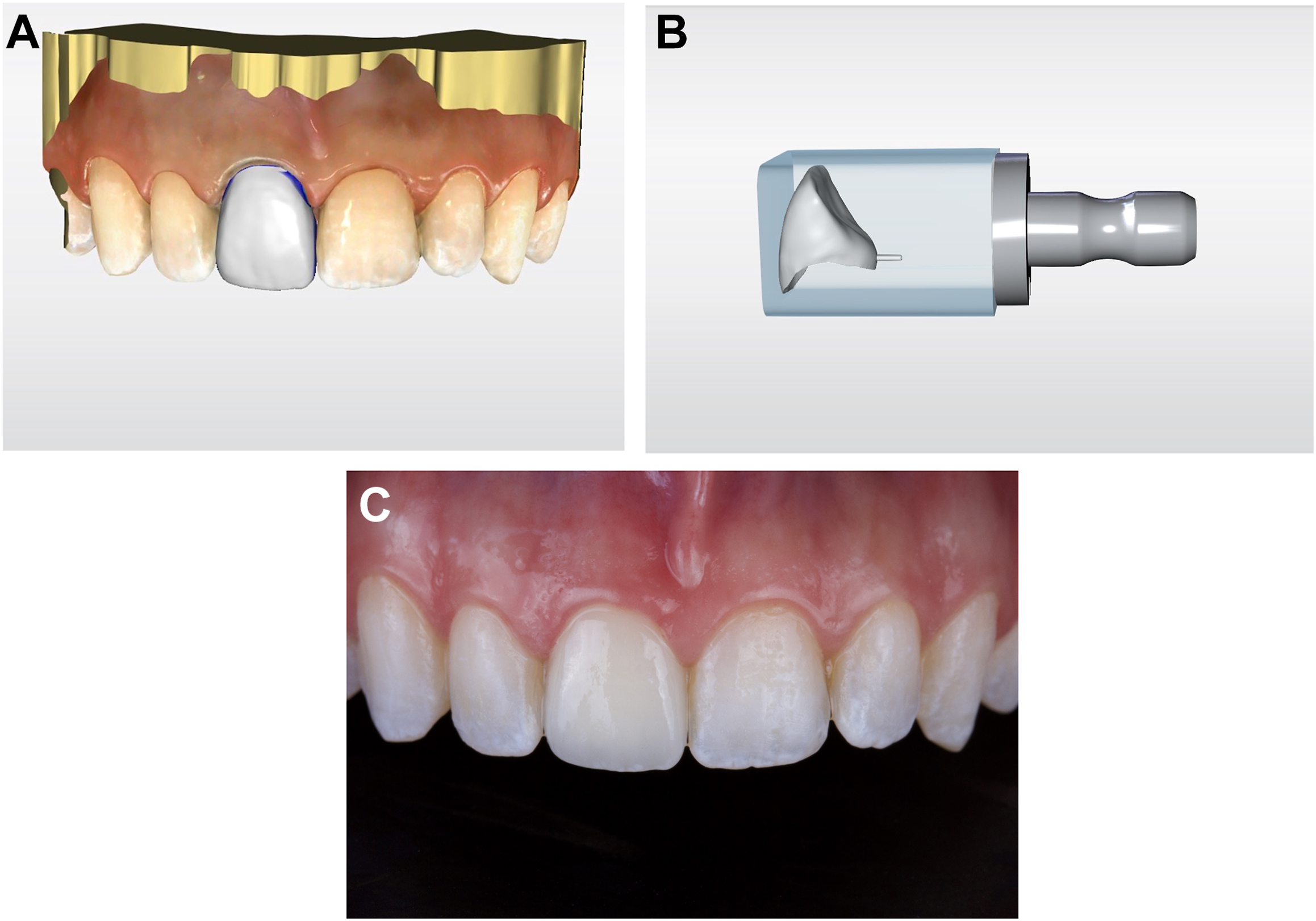 A set of three panels displays an A I-powered CAD slash C A M workflow showing a completed anterior crown restoration, a digital 3 D model of the prepared tooth, and a virtual design interface for crown placement.