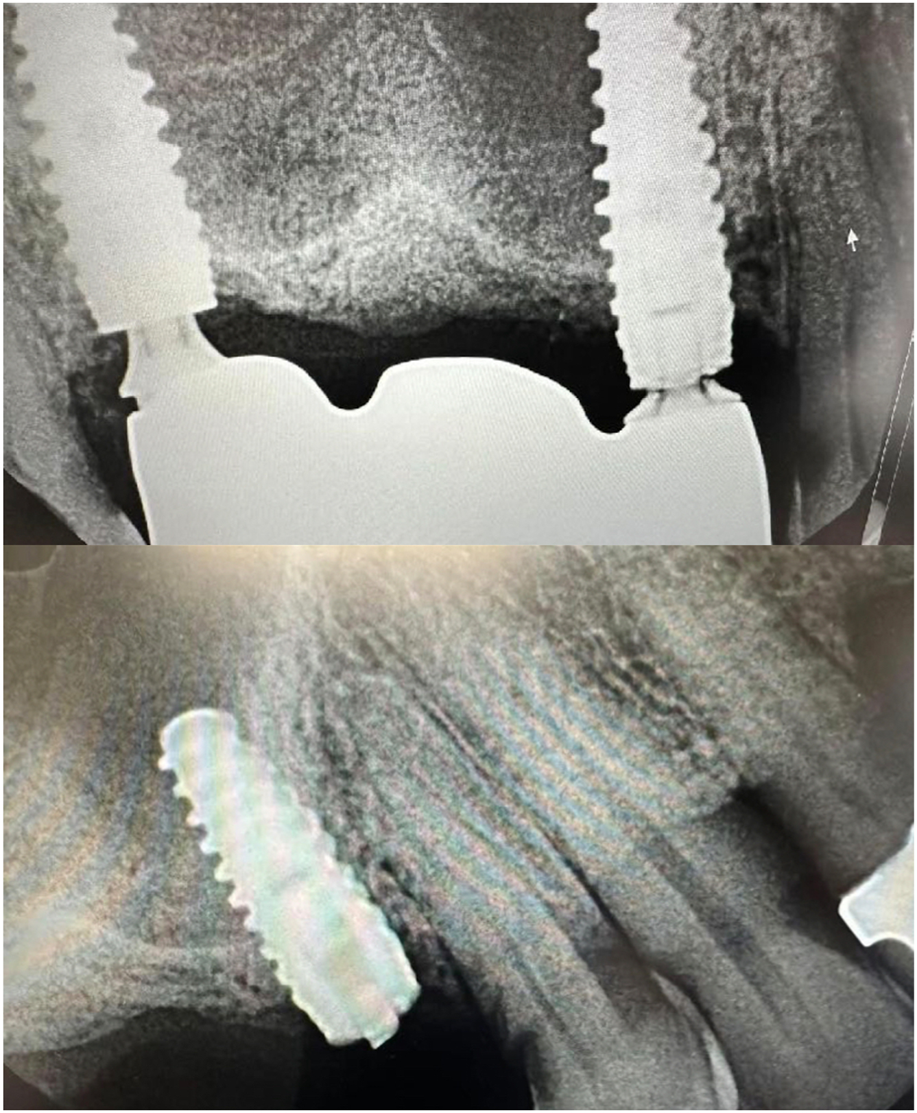 Two intraoral periapical radiographs display fractured dental implants.