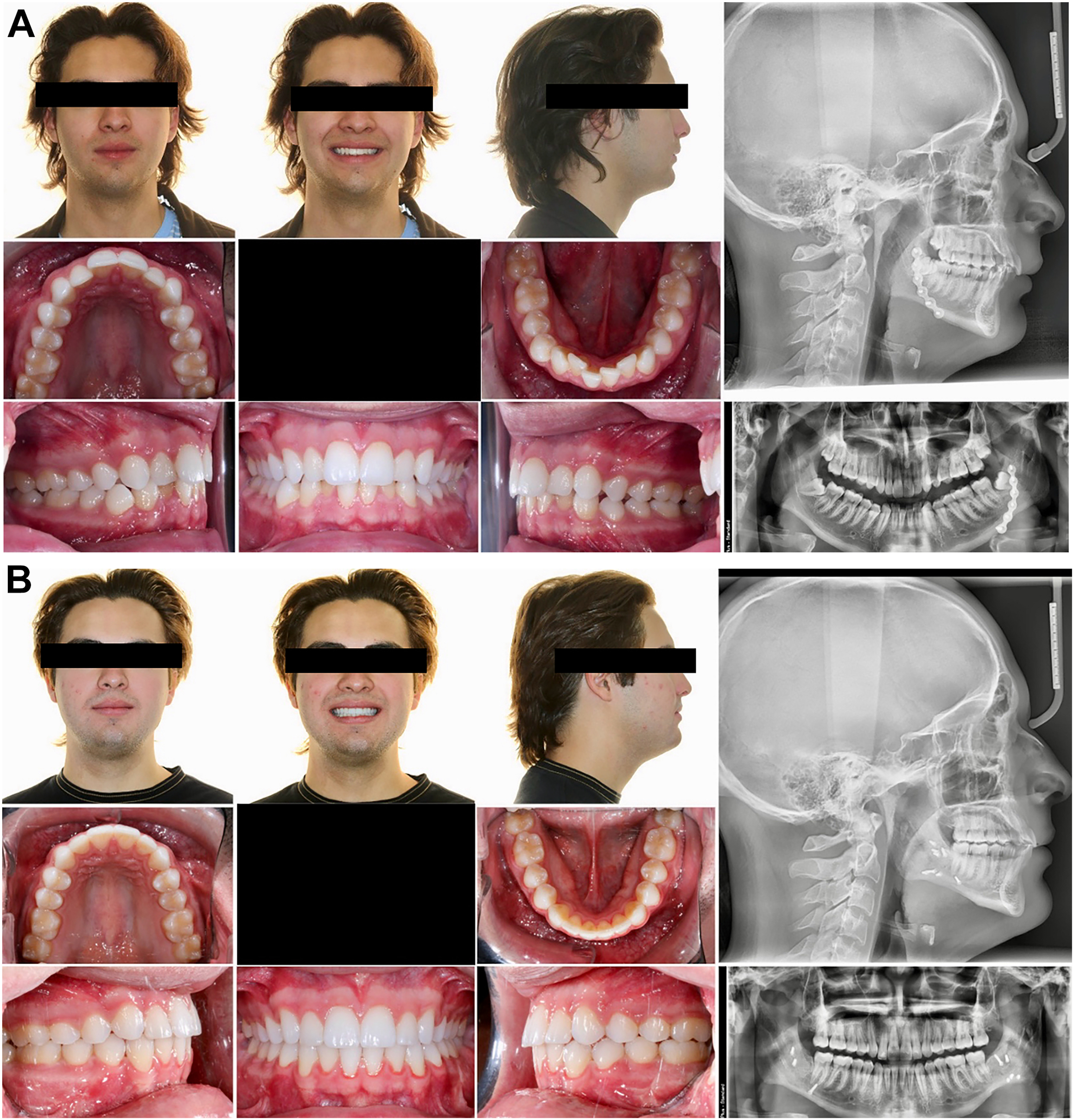 A set of two clinical photographs and radiographs compares a patient with multiple jaw fractures before and after corrective orthognathic surgery to restore proper occlusion.