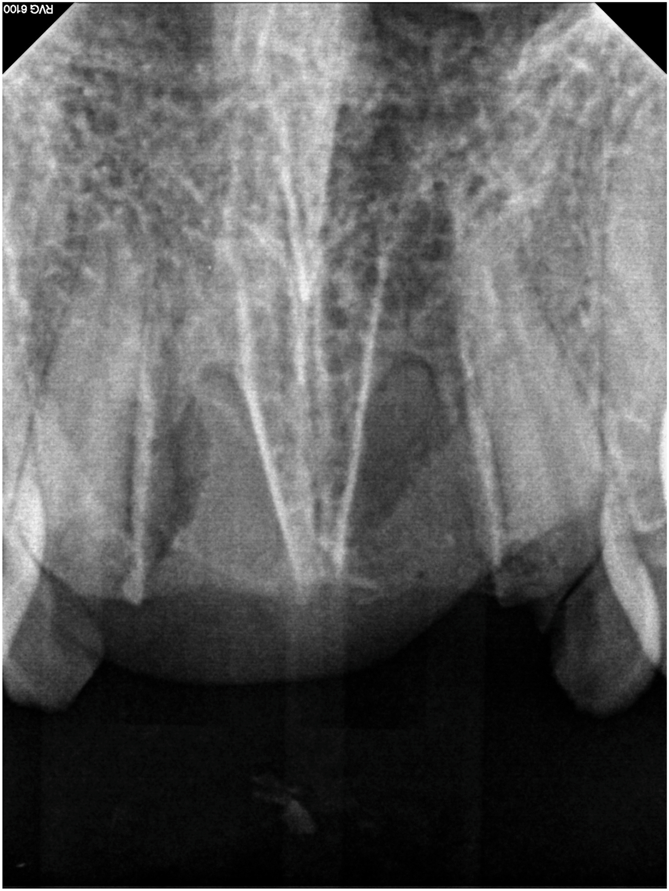 A periapical dental radiograph showing the upper anterior teeth with missing central incisors and fractures of the adjacent lateral incisors.