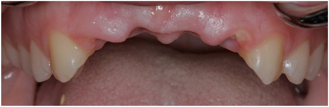 A clinical intraoral photograph showing the upper anterior ridge with papilla remnants between the canine teeth before ridge augmentation.
