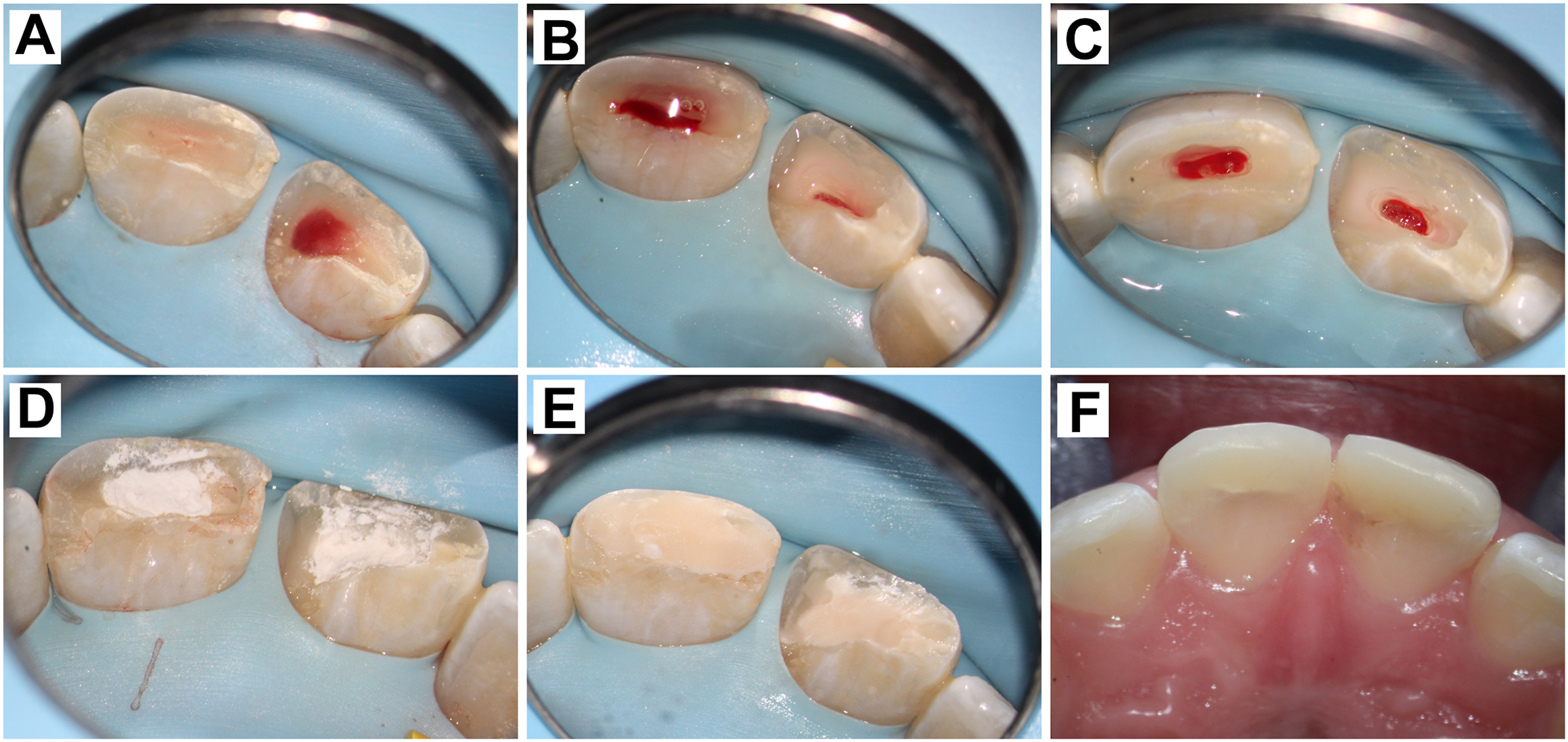A set of six photographs shows a step-by-step Cvek pulpotomy procedure on maxillary central incisors following traumatic fractures and pulp exposure.