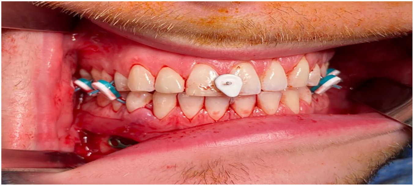 A photograph shows the clinical application of dental occlusion ties on a patient following a surgical procedure.