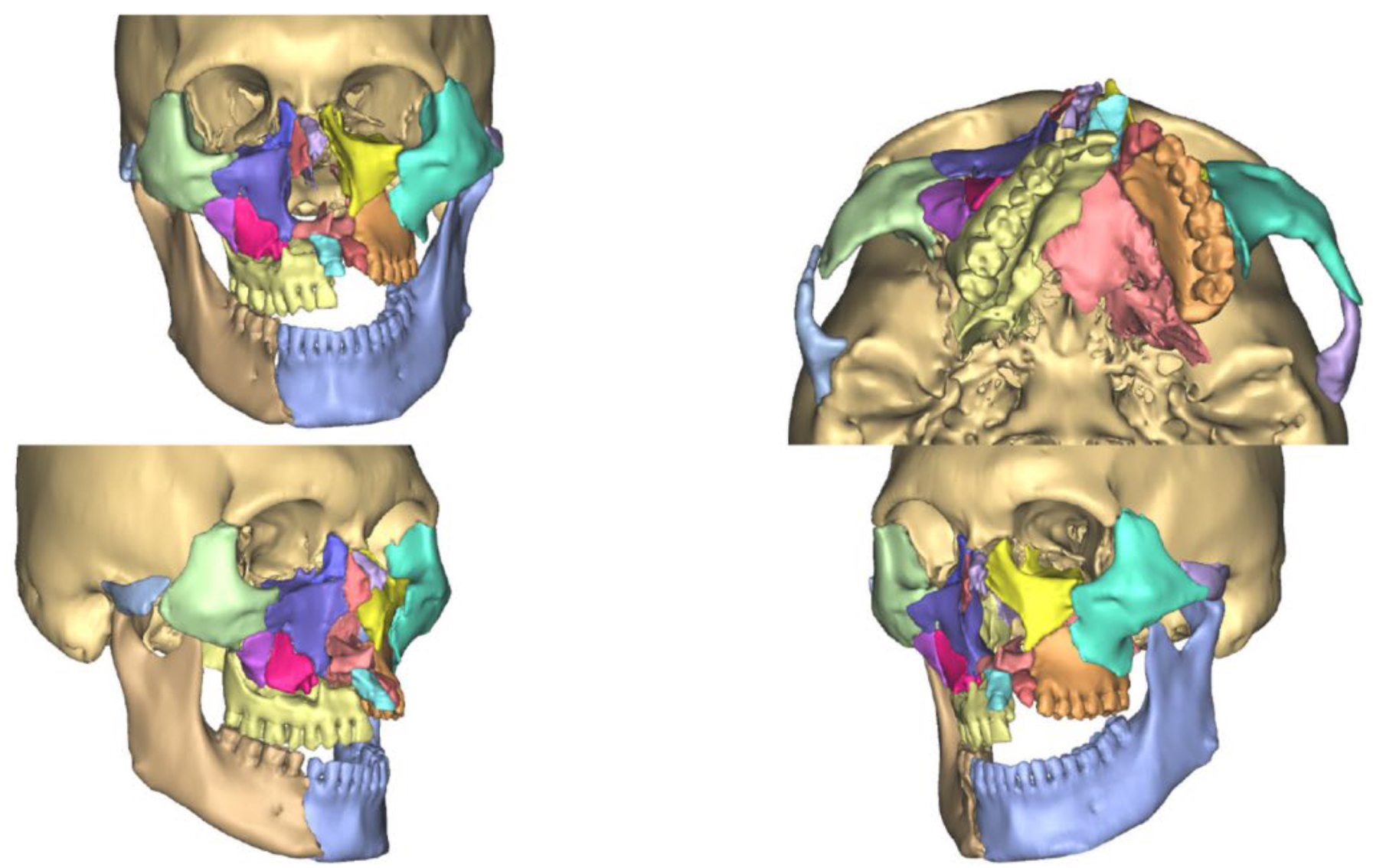A four-view composite of C T reconstruction scans depicts color-segmented fractured anatomical subunits of the midface and mandible for virtual surgical reconstruction planning.