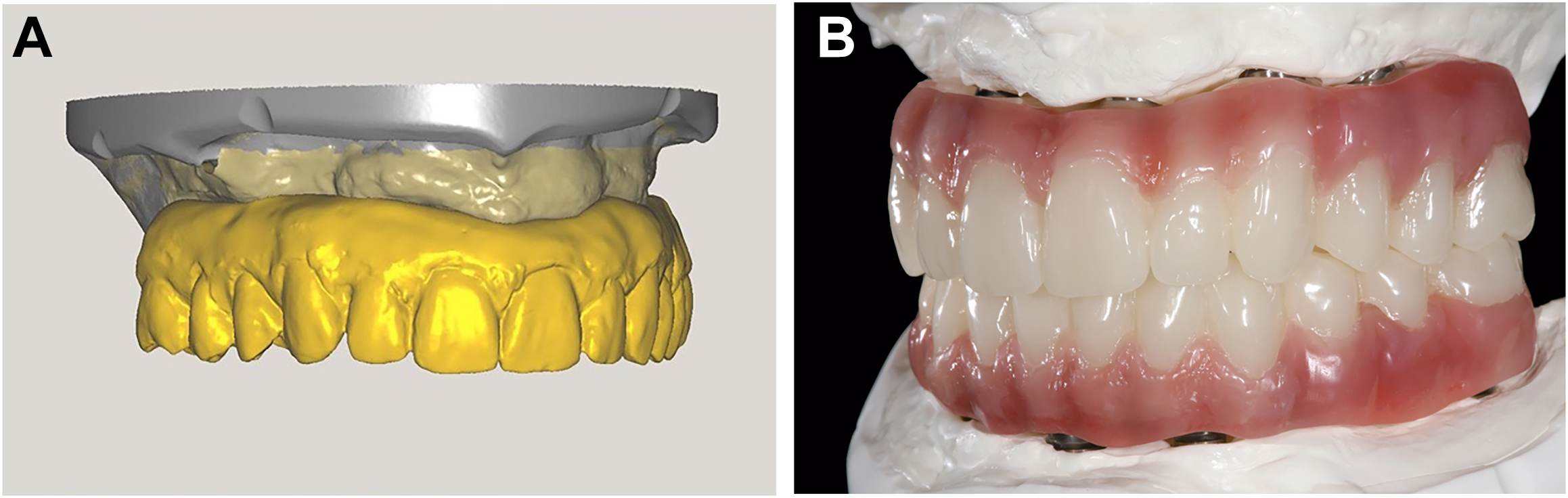 Two panels show a digital dental model and a full-mouth implant-supported overdenture.