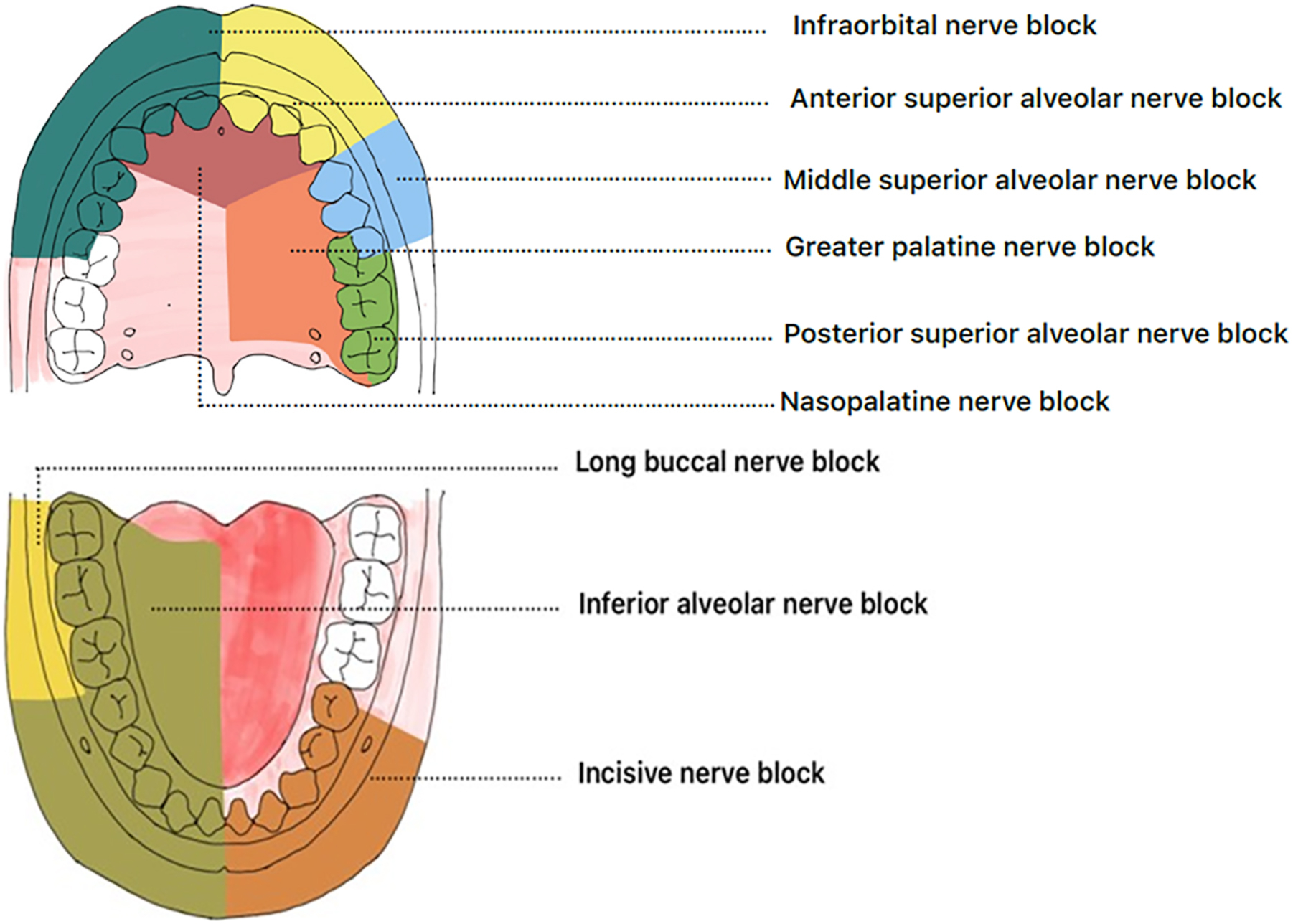 A labeled anatomical diagram of the maxillary and mandibular arches, with regions innervated by various dental nerve blocks.