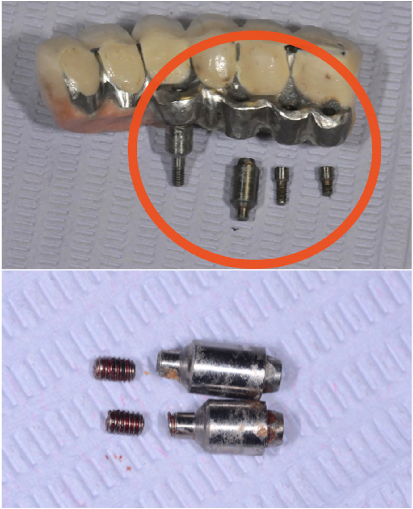 Two medical photos present fractured implant screws and a fixed prosthesis.