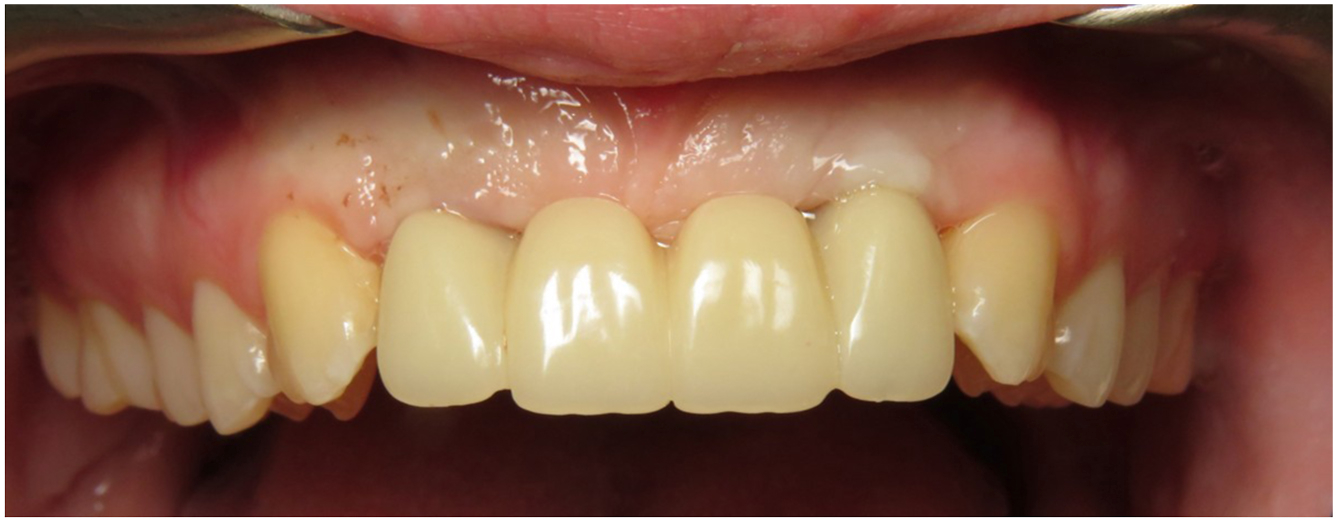 A clinical intraoral photograph showing the upper front teeth restored with a provisional implant-supported prosthesis.