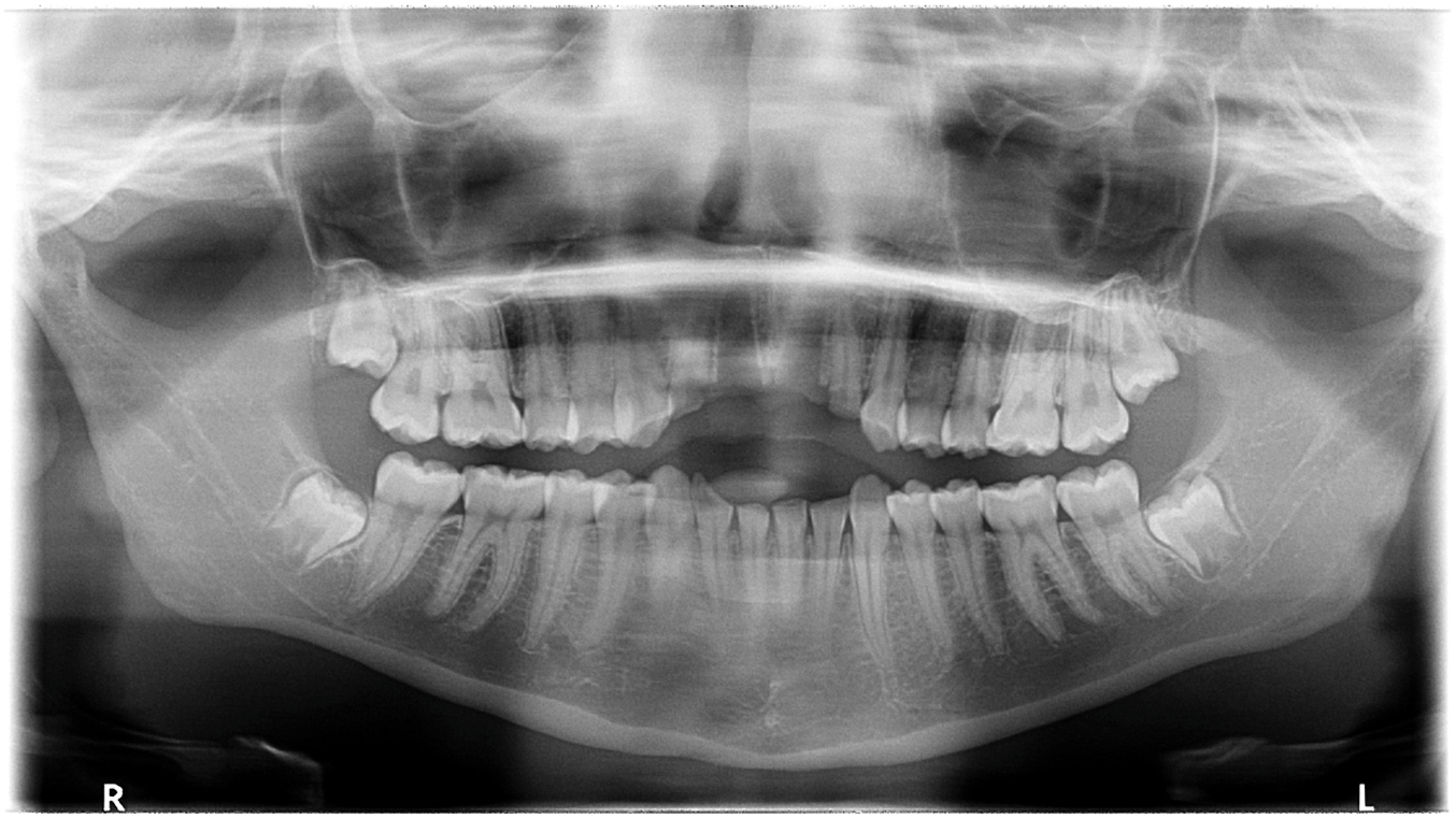 A panoramic dental radiograph showing avulsed upper central incisors, fractures of the adjacent lateral incisors, and injuries involving mandibular teeth.