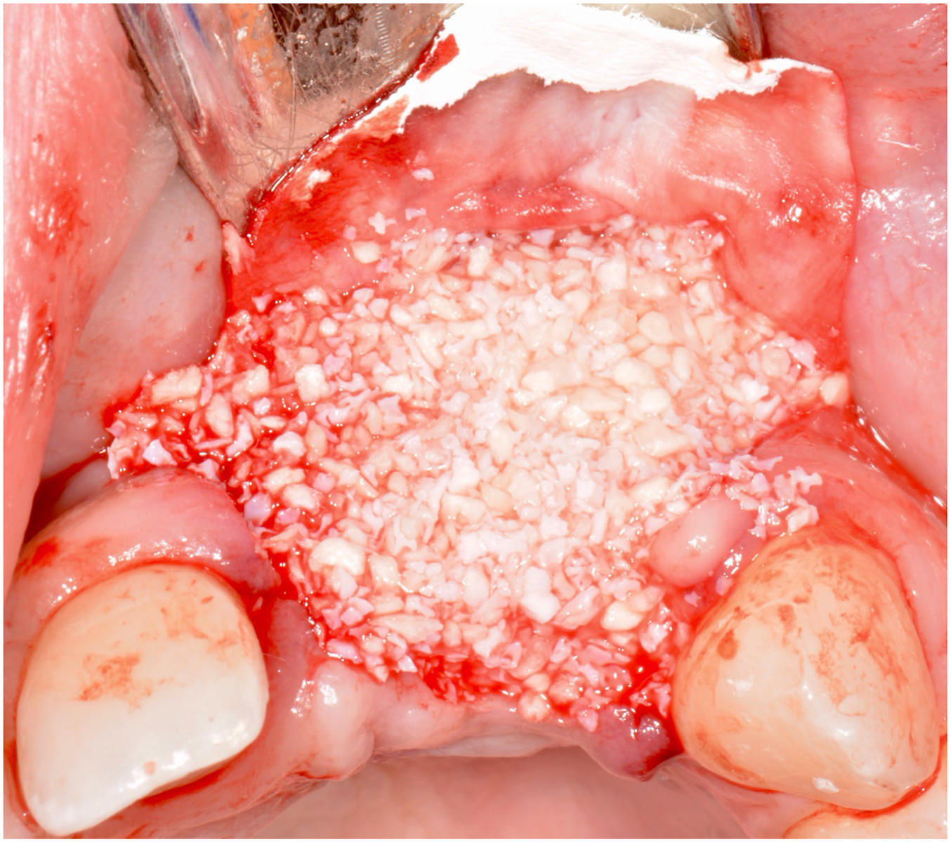 A close-up surgical intraoral view shows a large dental extraction site in the upper jaw filled with granular white bone graft material, held open by a metal retractor.